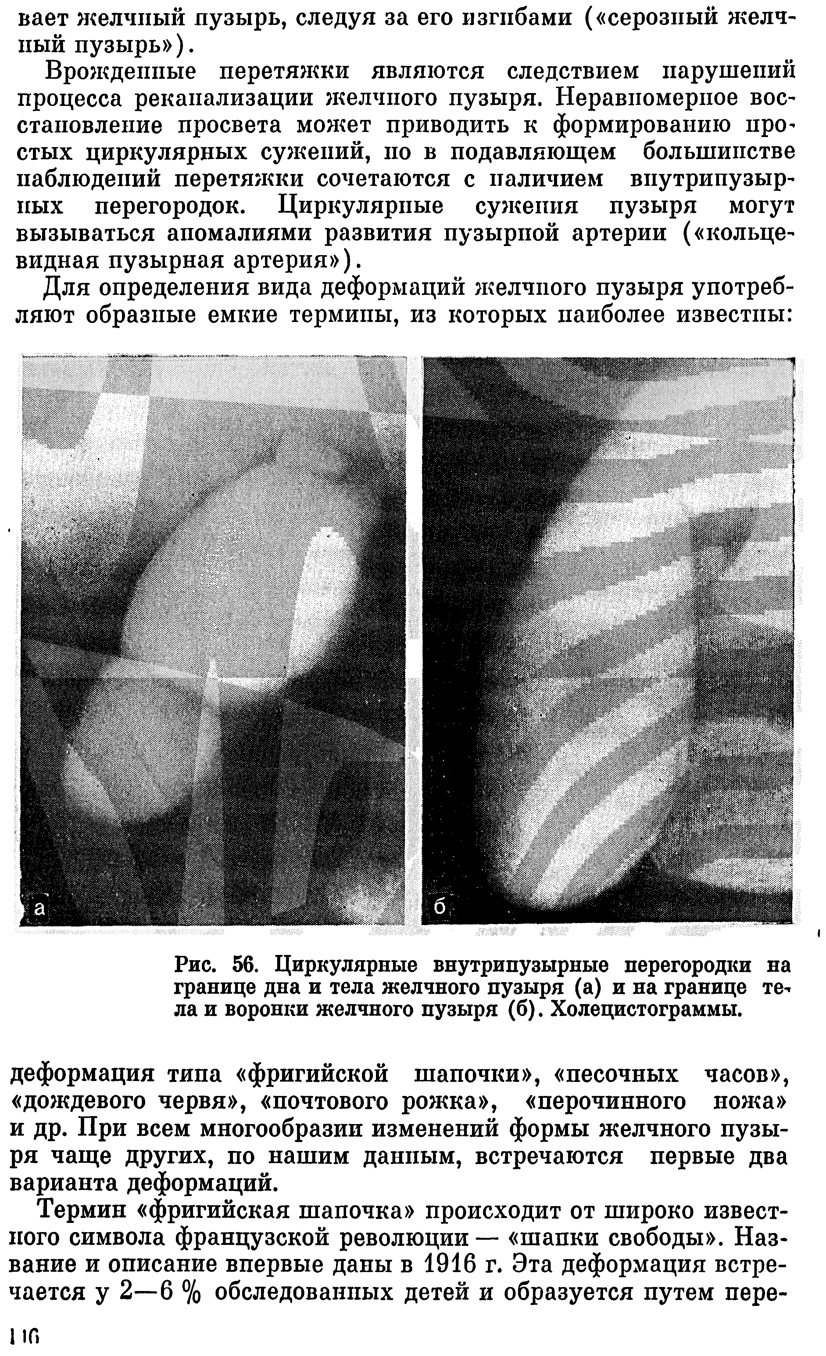 Рис. 56. Циркулярные внутрипузырные перегородки на границе дна и тела желчного пузыря (а) и на границе тела и воронки желчного пузыря (б). Холецистограммы.