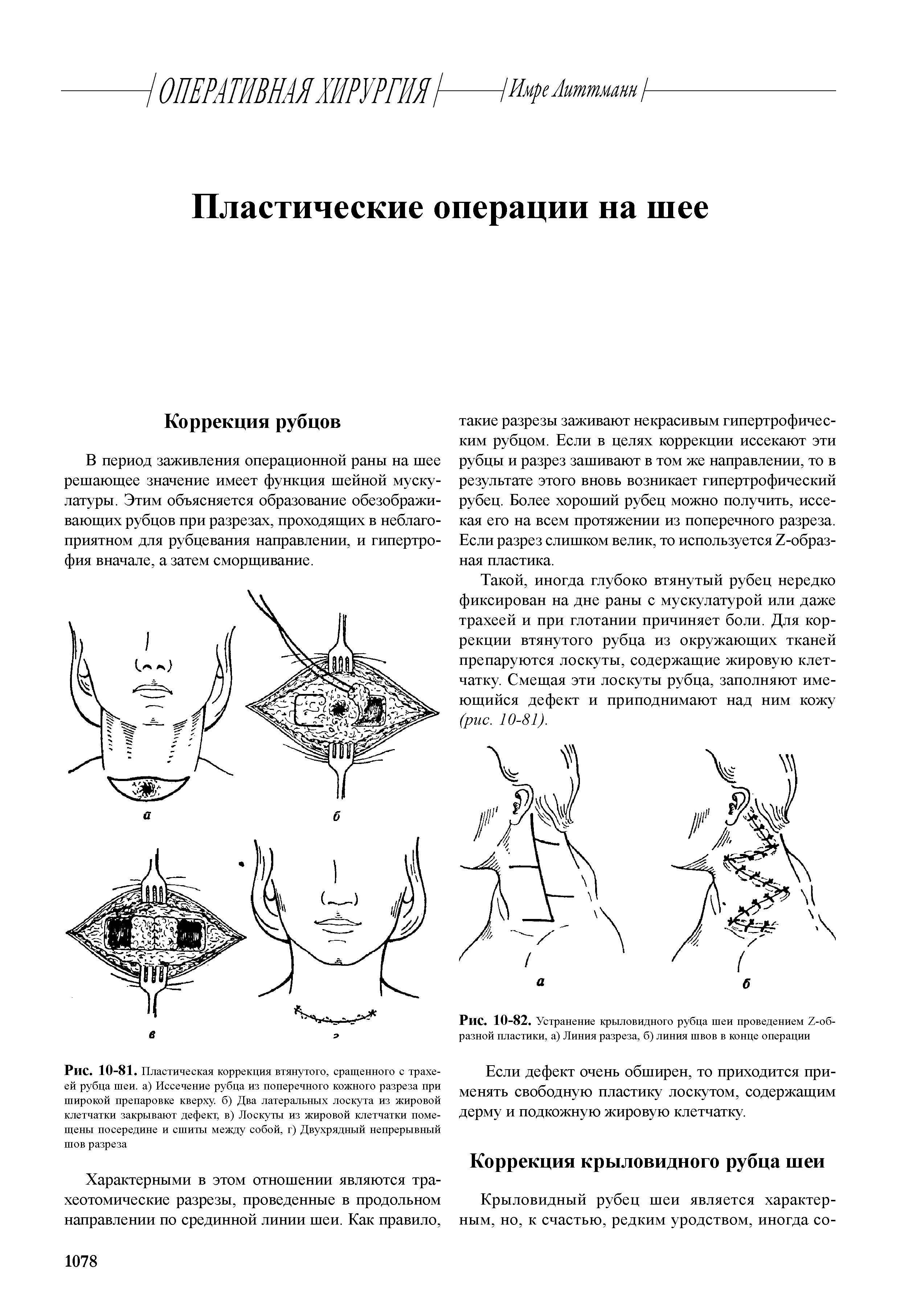 Рис. 10-81. Пластическая коррекция втянутого, сращенного с трахеей рубца шеи. а) Иссечение рубца из поперечного кожного разреза при широкой препаровке кверху, б) Два латеральных лоскута из жировой клетчатки закрывают дефект, в) Лоскуты из жировой клетчатки помещены посередине и сшиты между собой, г) Двухрядный непрерывный шов разреза...