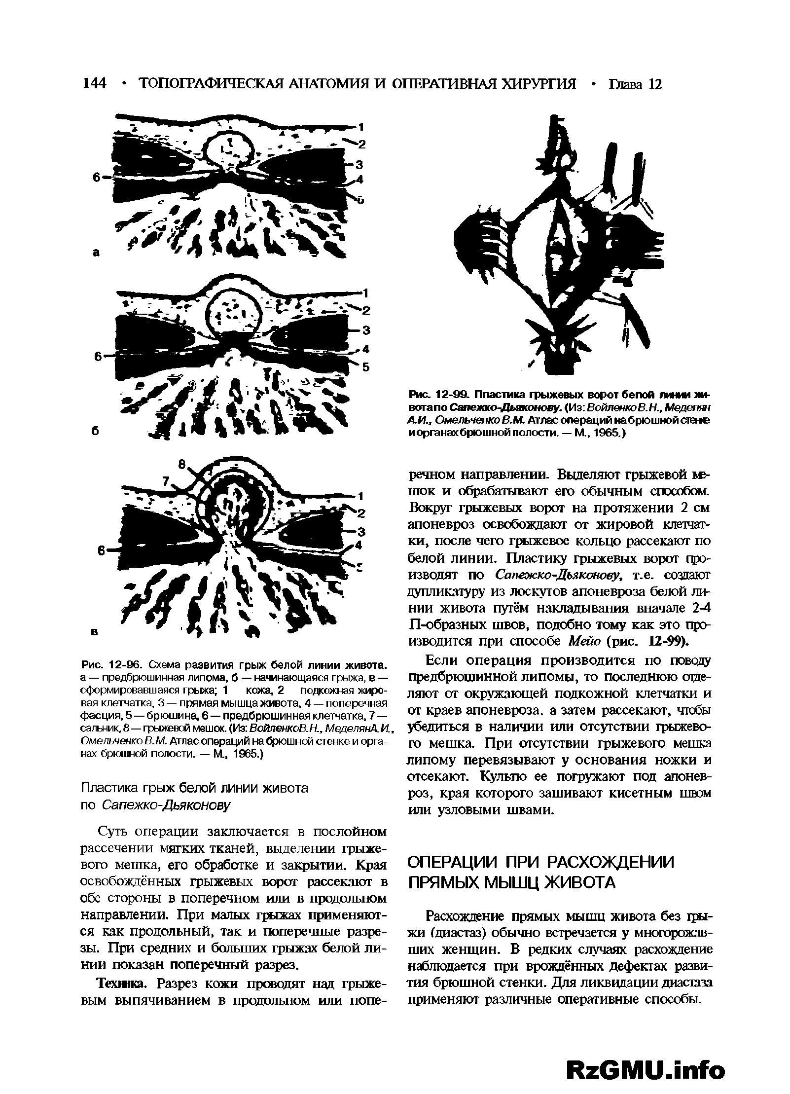 Рис. 12-96. Схема развития грыж белой линии живота, а — предбрюшинмая липома, б — начинающаяся грыжа, в — сформировавшаяся грыжа 1 кожа, 2 подкожная жировая клетчатка, 3 — прямая мышца живота, 4 —поперечная фасция, 5—брюшина, 6 — предбрюшинная клетчатка, 7— сальник, 8—грыжевой мешок. (Из ВойленкоВ.Н., МеделянА.И Омельченко В.М. Атлас операций на брюшной стенке и органах брюшной полости. — М 1965.)...