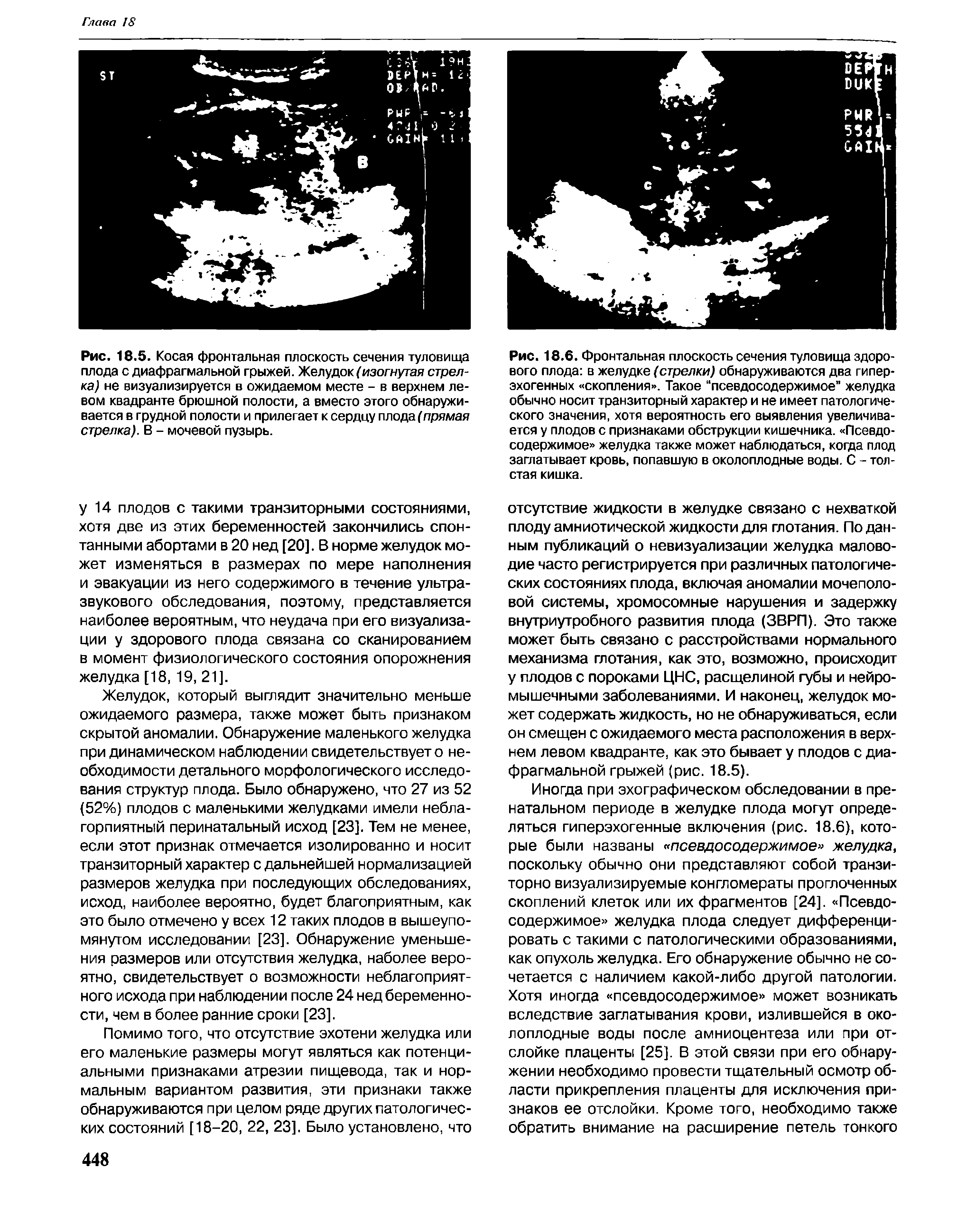 Рис. 18.5. Косая фронтальная плоскость сечения туловища плода с диафрагмальной грыжей. Желудок (изогнутая стрелка) не визуализируется в ожидаемом месте - в верхнем левом квадранте брюшной полости, а вместо этого обнаруживается в грудной полости и прилегает к сердцу плода (прямая стрелка). В - мочевой пузырь.