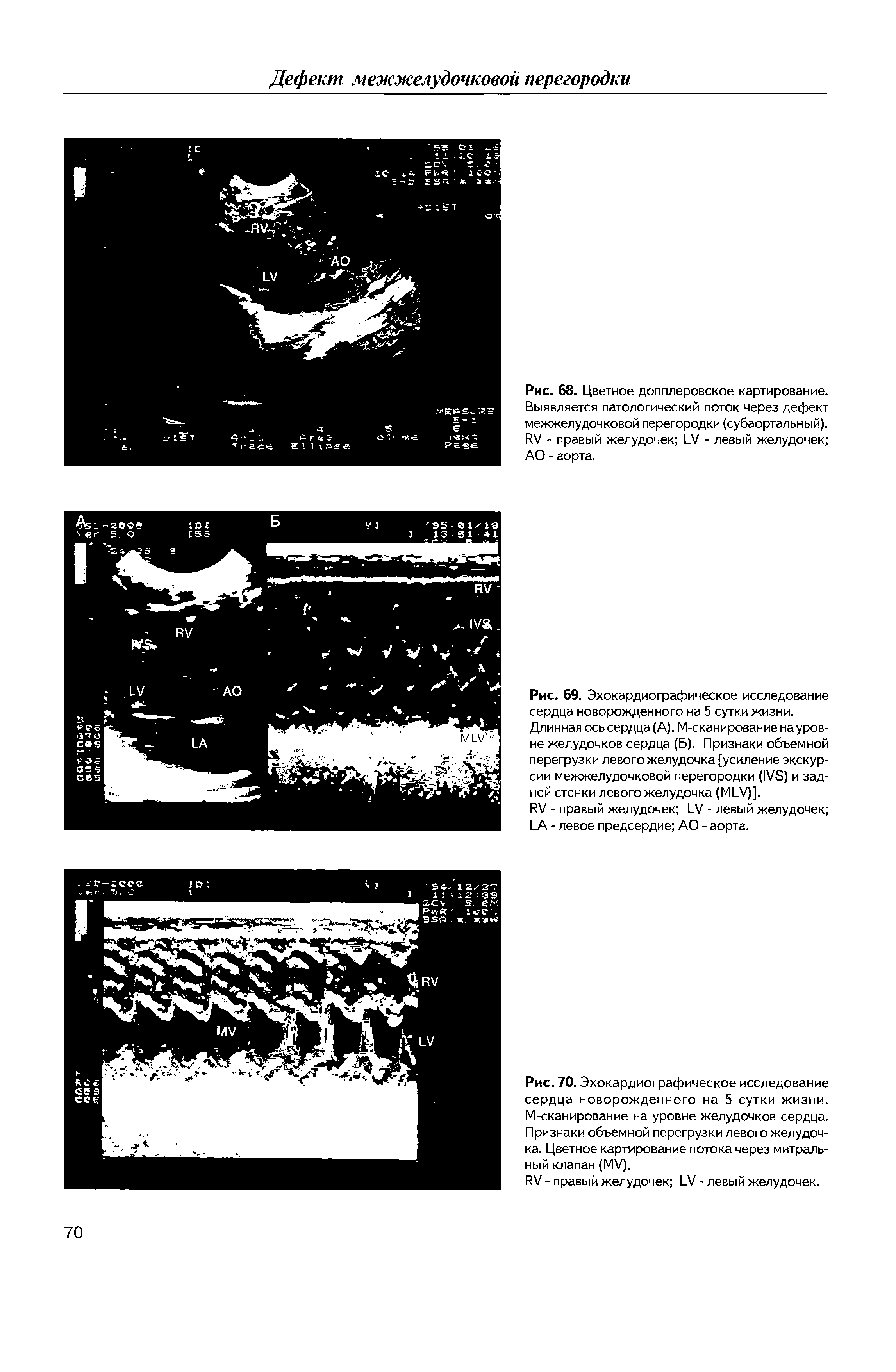 Рис. 69. Эхокардиографическое исследование сердца новорожденного на 5 сутки жизни. Длинная ось сердца (А). М-сканирование на уровне желудочков сердца (Б). Признаки объемной перегрузки левого желудочка [усиление экскурсии межжелудочковой перегородки (1УЭ) и задней стенки левого желудочка (М1 У)].