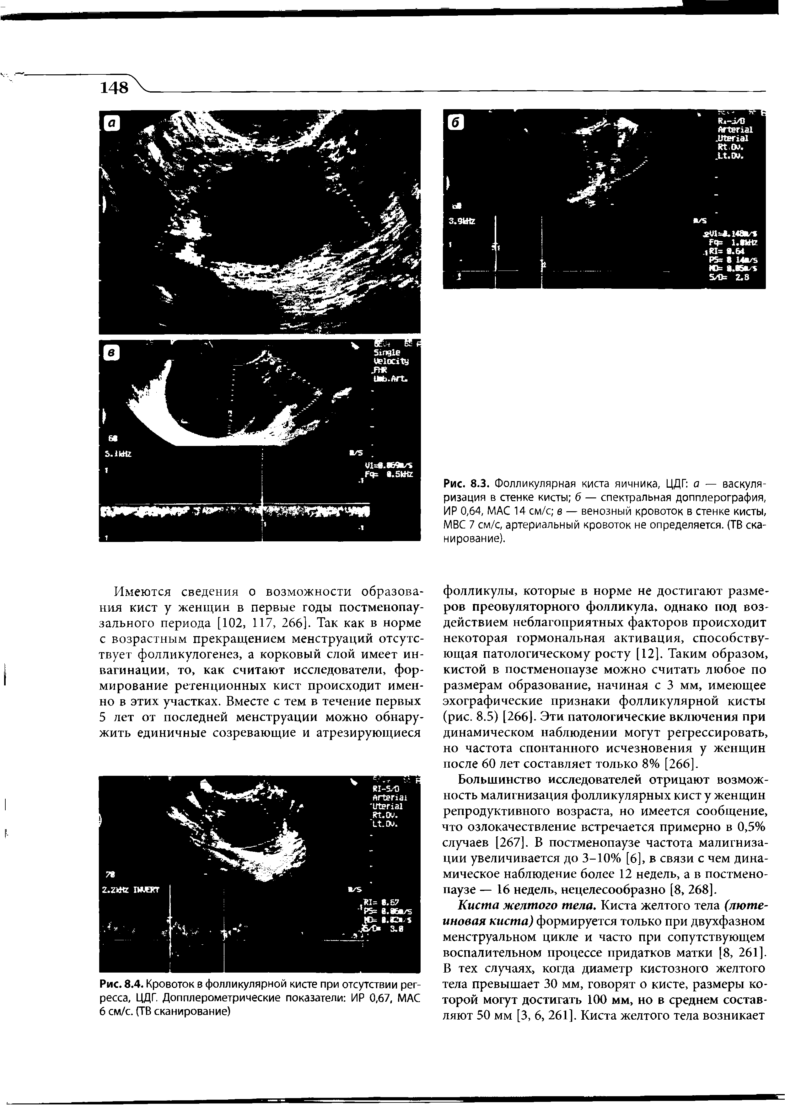 Рис. 8.3. Фолликулярная киста яичника, ЦДГ а — васкуляризация в стенке кисты б — спектральная допплерография, ИР 0,64, МАС 14 см/с в — венозный кровоток в стенке кисты, МВС 7 см/с, артериальный кровоток не определяется. (ТВ сканирование).