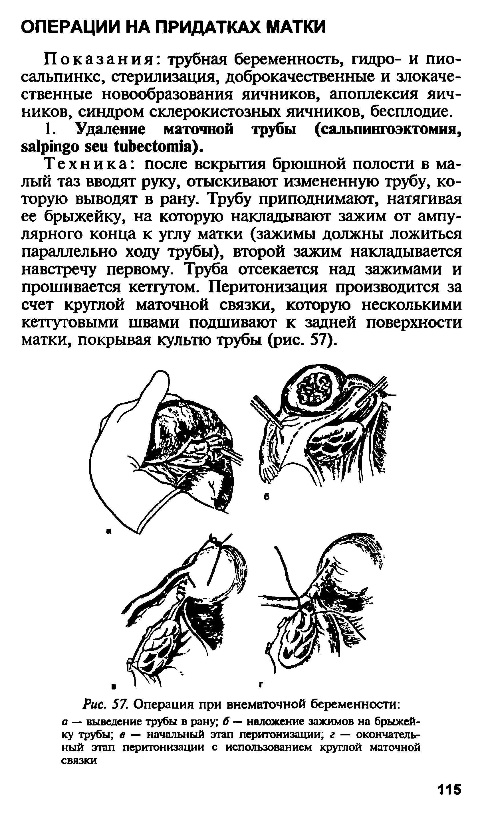 Рис. 57. Операция при внематочной беременности а — выведение трубы в рану б — наложение зажимов на брыжейку трубы в — начальный этап перитонизации г — окончательный этап перитонизации с использованием круглой маточной связки...