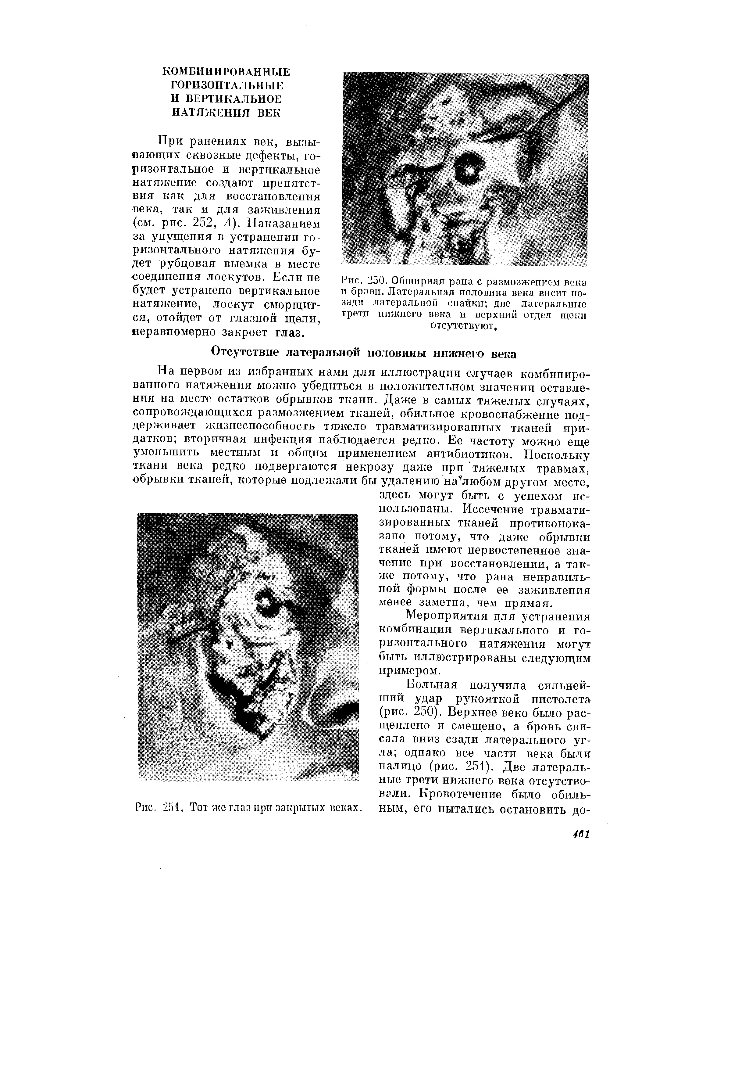 Рис.. 250. Обширная рана с размозжением века и брови. Латеральная половина века висит позади латеральной спайки две латеральные трети нижнего века и верхний отдел щеки отсутствуют.