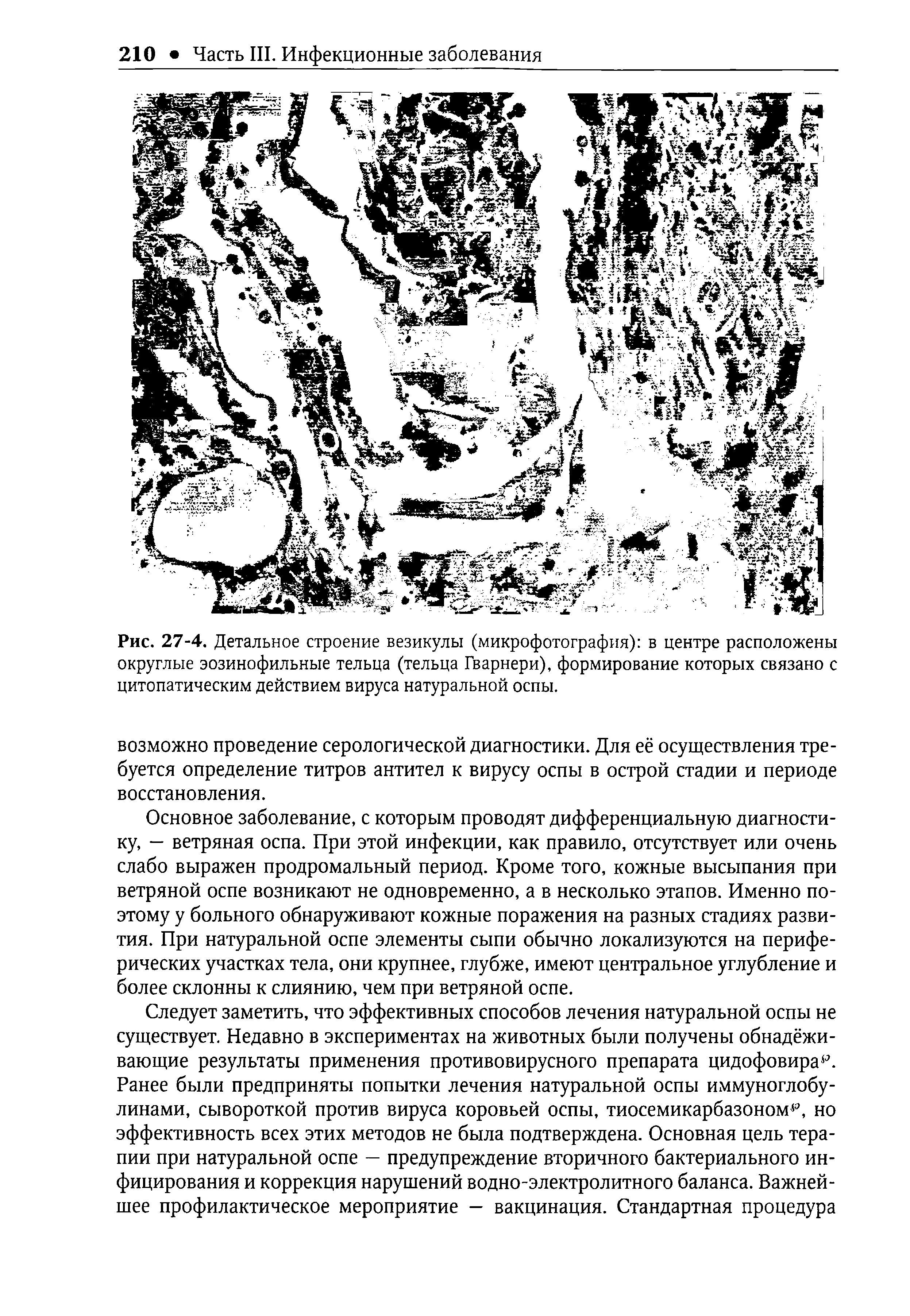 Рис. 27-4. Детальное строение везикулы (микрофотография) в центре расположены округлые эозинофильные тельца (тельца Гварнери), формирование которых связано с цитопатическим действием вируса натуральной оспы.