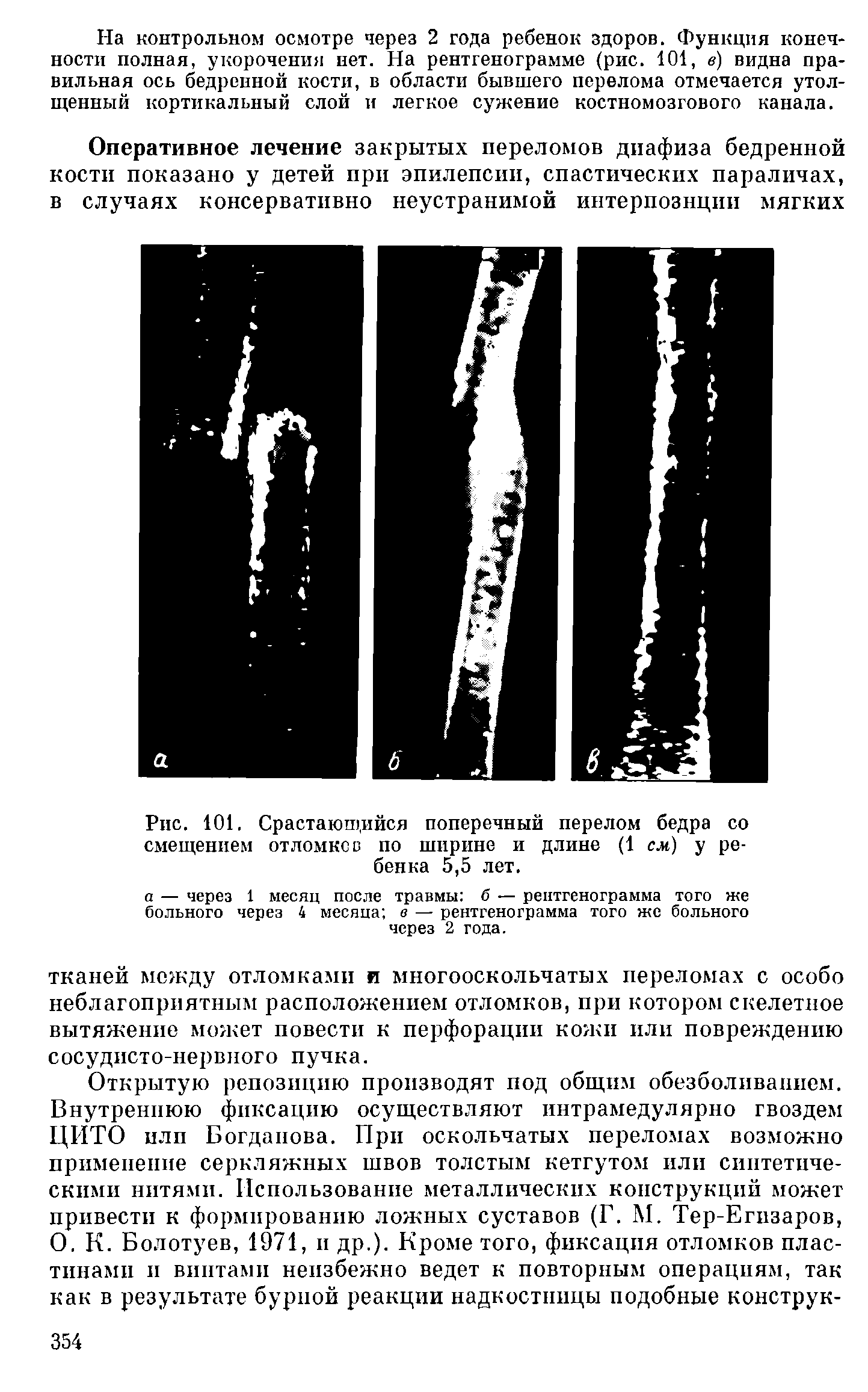 Рис. 101. Срастаюпщйся поперечный перелом бедра со смещением отломков по ширине и длине (1 см) у ребенка 5,5 лет.