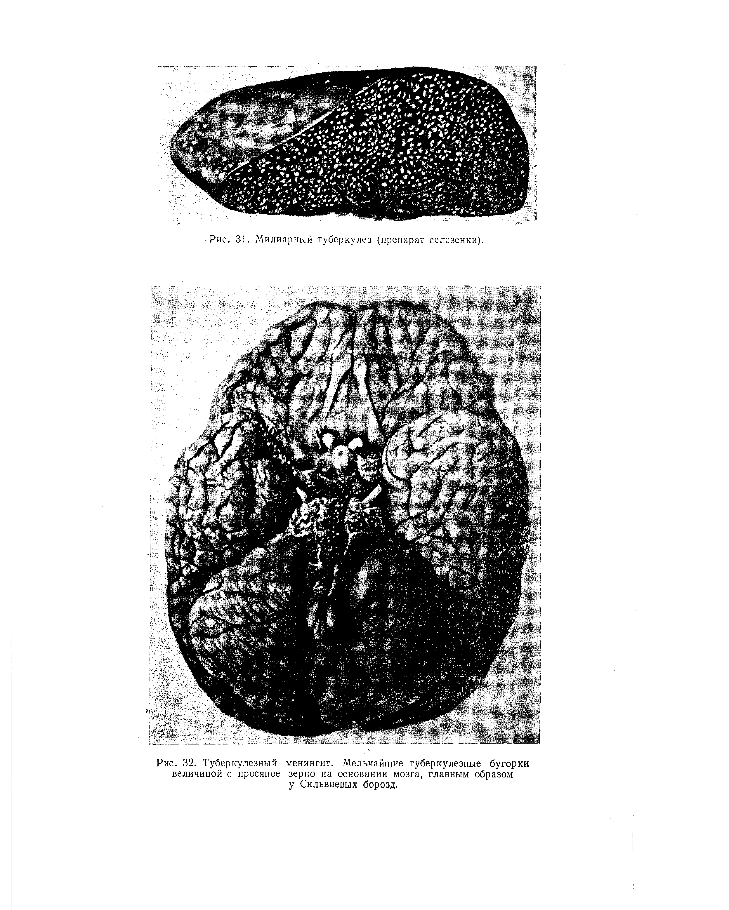 Рис. 32. Туберкулезный менингит. Мельчайшие туберкулезные бугорки величиной с просяное зерно на основании мозга, главным образом у Сильвиевых борозд.