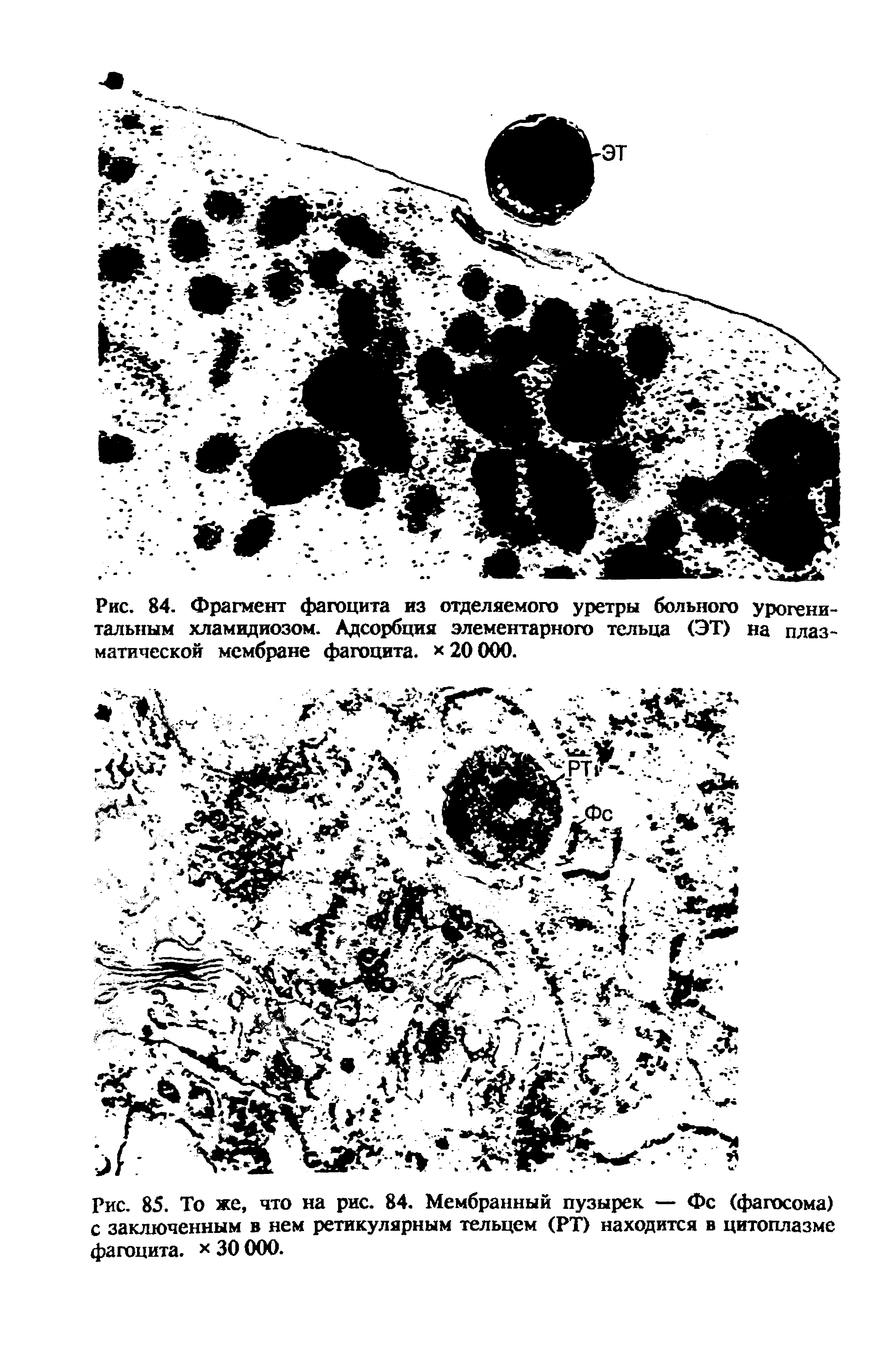 Рис. 84. Фрагмент фагоцита из отделяемого уретры больного урогенитальным хламидиозом. Адсорбция элементарного тельца (ЭТ) на плазматической мембране фагоцита, х 20 000.