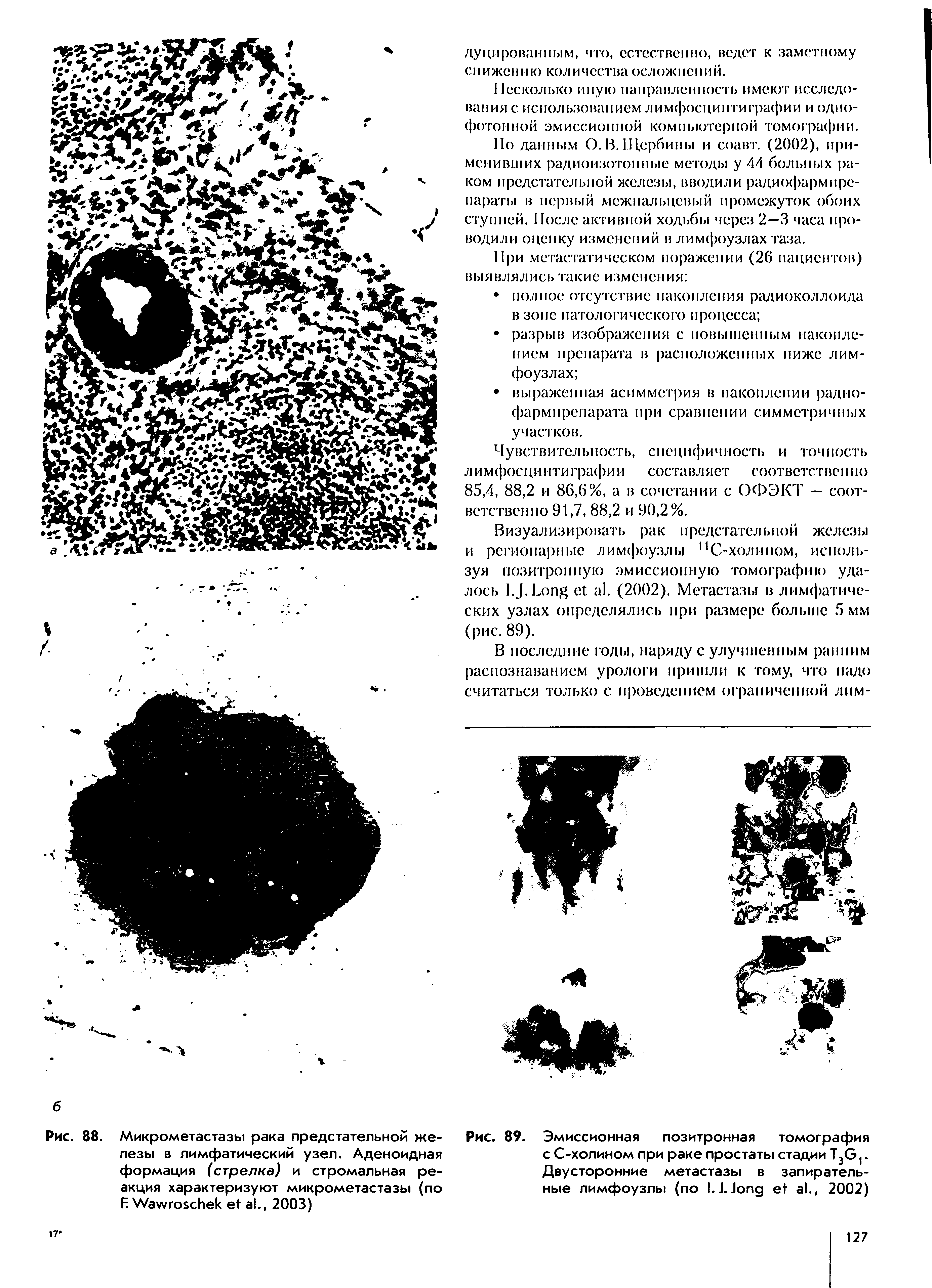 Рис. 89. Эмиссионная позитронная томография с С-холином при раке простаты стадии T3G1. Двусторонние метастазы в запирательные лимфоузлы (по I.J.J ., 2002)...