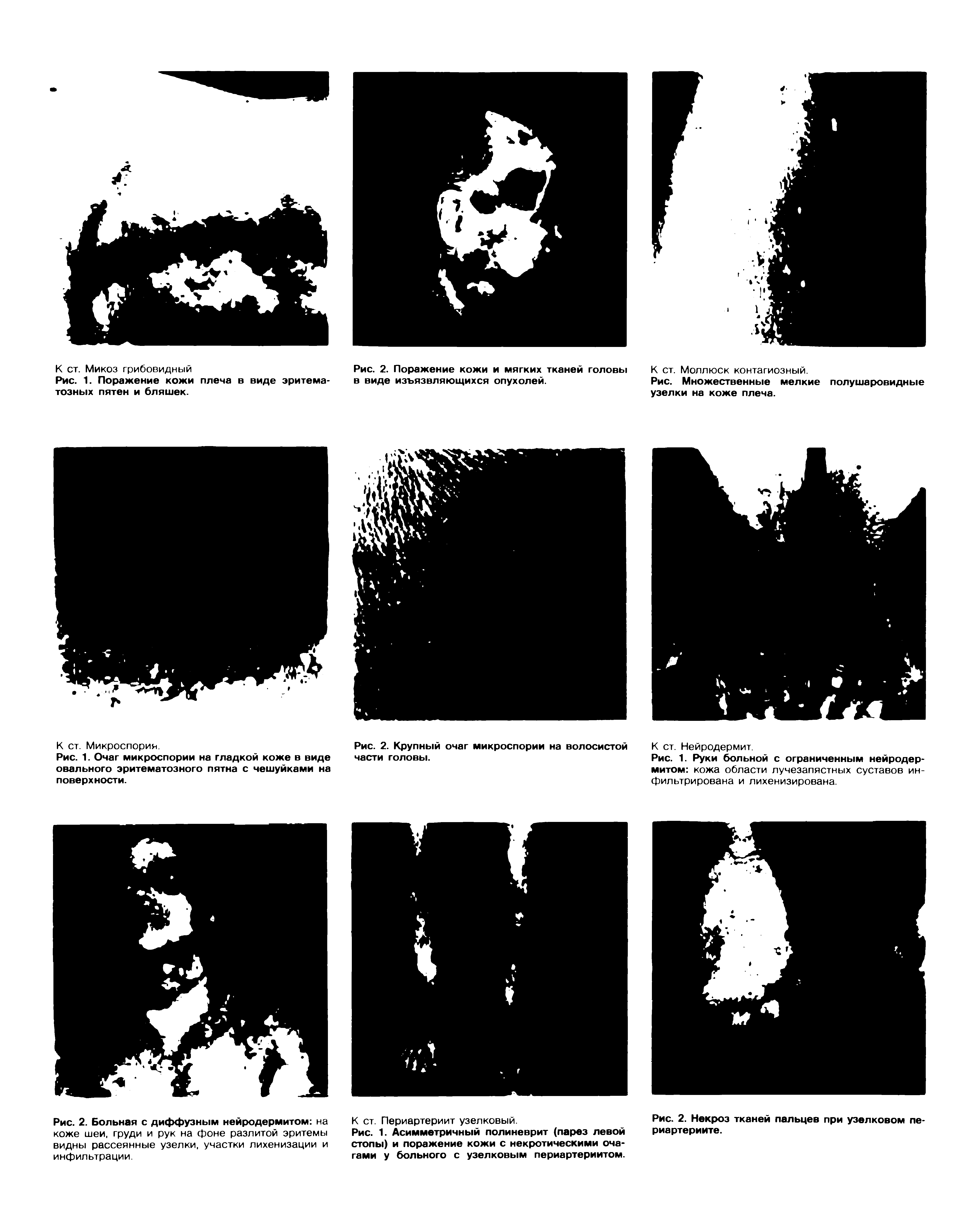 Рис. Множественные мелкие полушаровидные узелки на коже плеча.