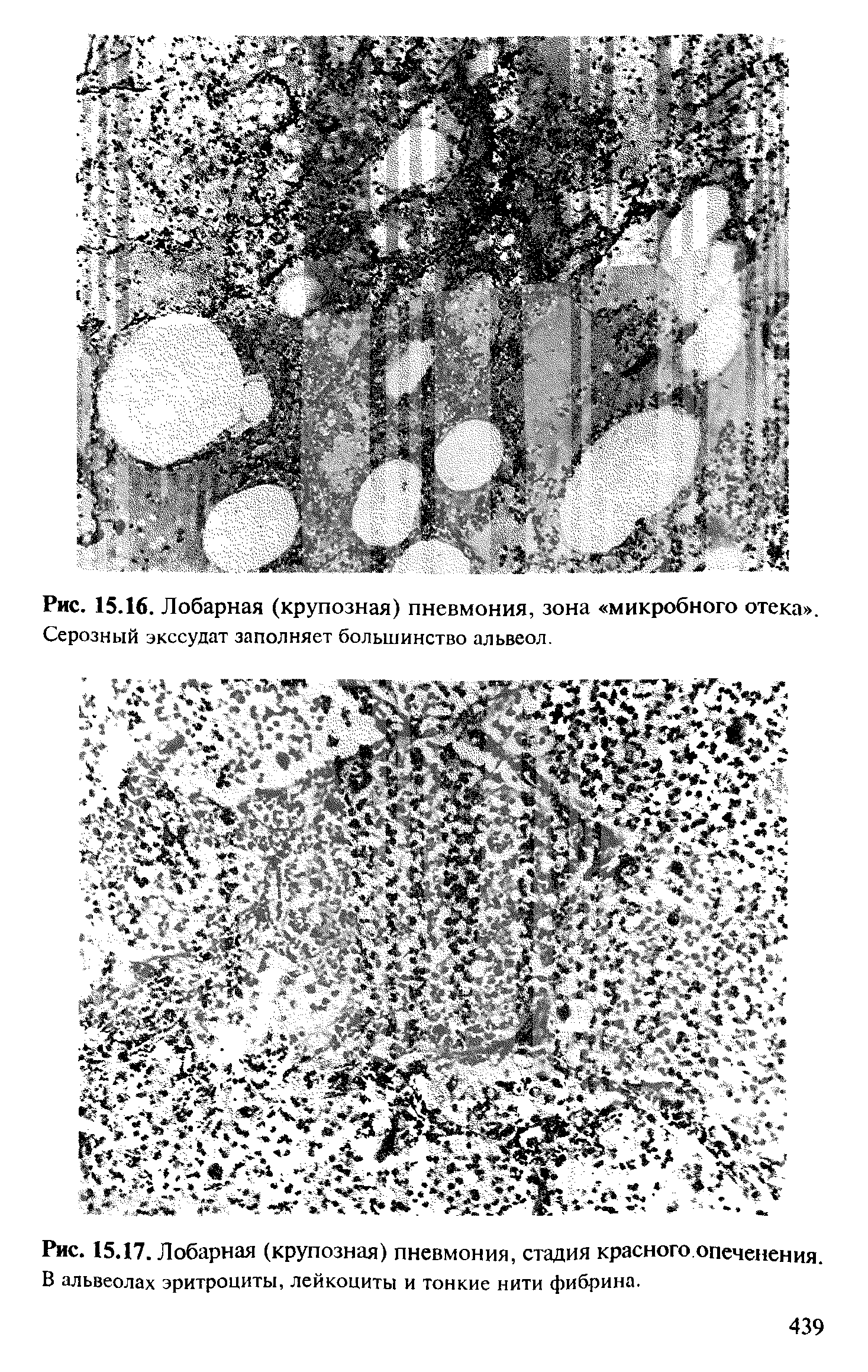 Рис. 15.17. Лобарная (крупозная) пневмония, стадия красного опеченения. В альвеолах эритроциты, лейкоциты и тонкие нити фибрина.