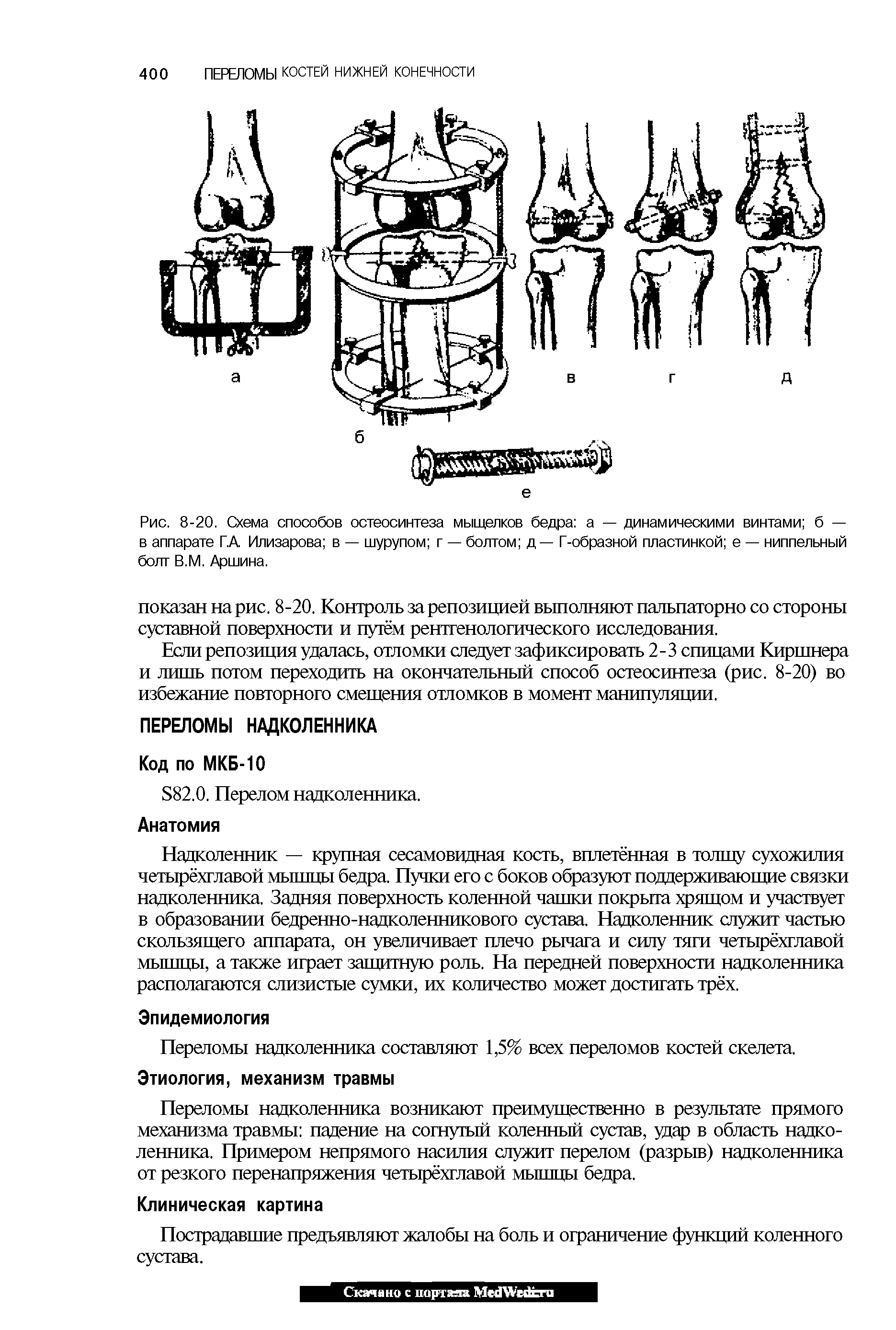 Рис. 8-20. Схема способов остеосинтеза мыщелков бедра а — динамическими винтами б — в аппарате ГА Илизарова в — шурупом г — болтом д— Г-образной пластинкой е — ниппельный болт В.М. Аршина.