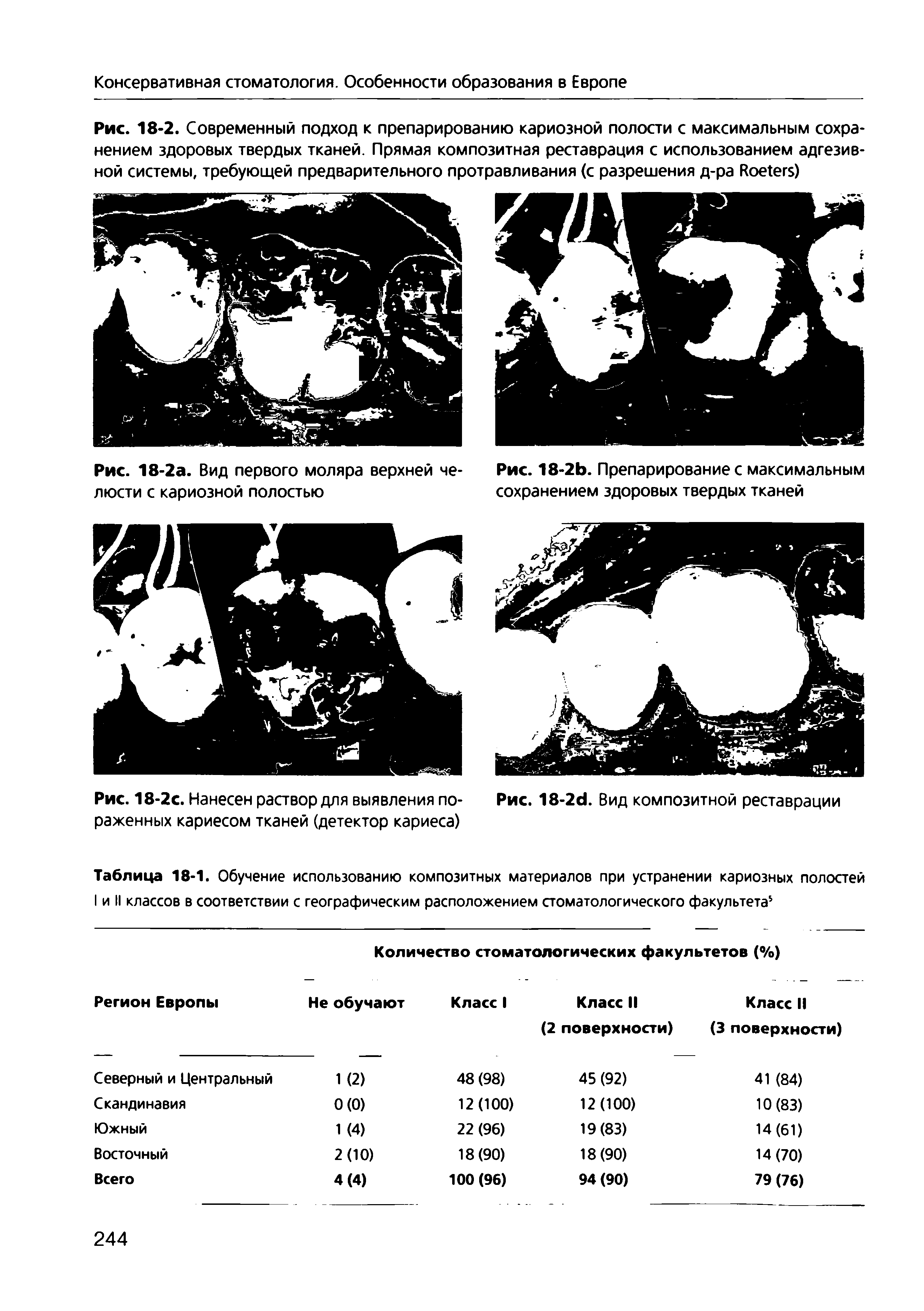 Рис. 18-2с. Нанесен раствор для выявления пораженных кариесом тканей (детектор кариеса)...