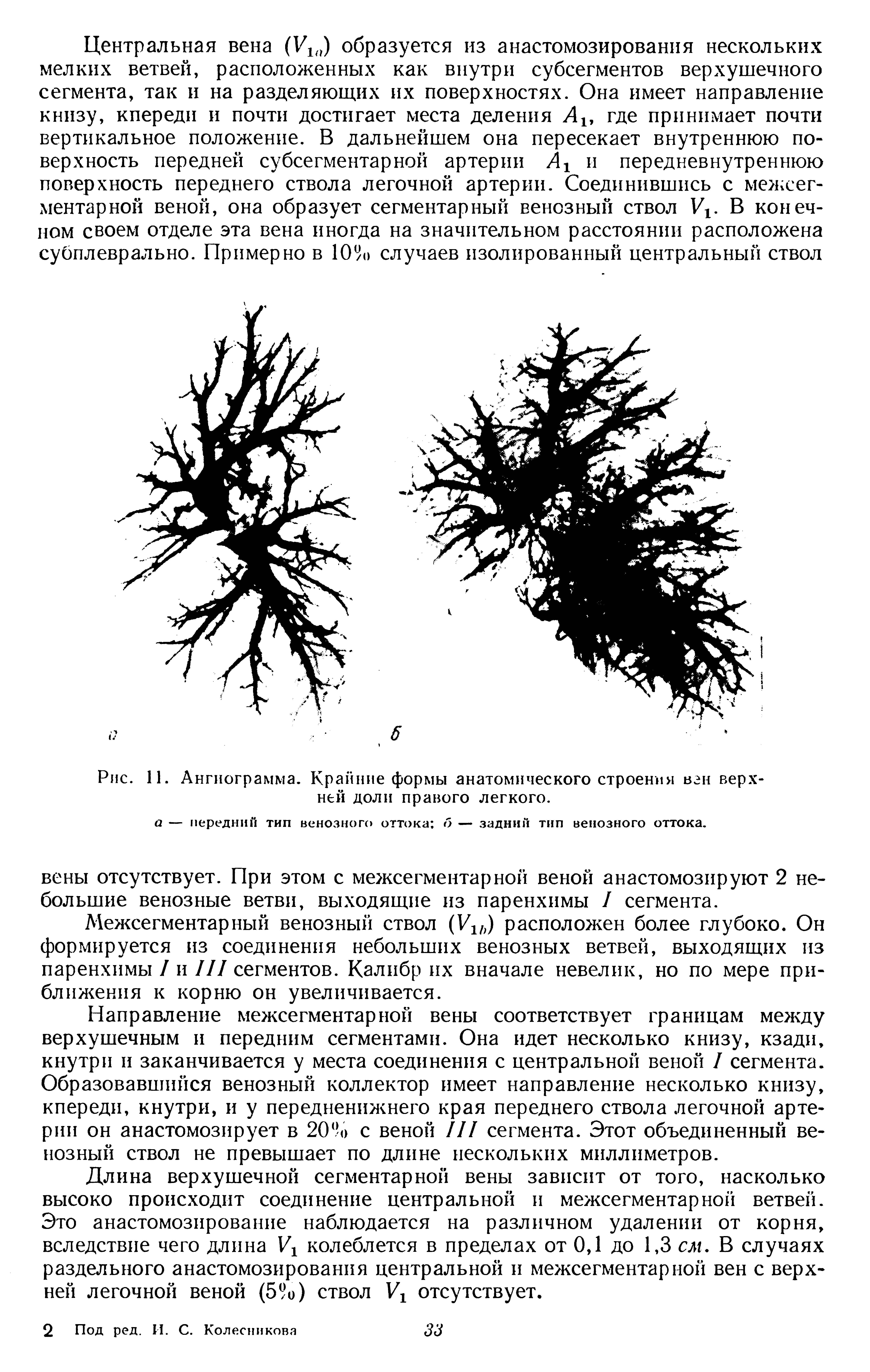 Рис. И. Ангиограмма. Крайние формы анатомического строения вен верхней доли правого легкого.