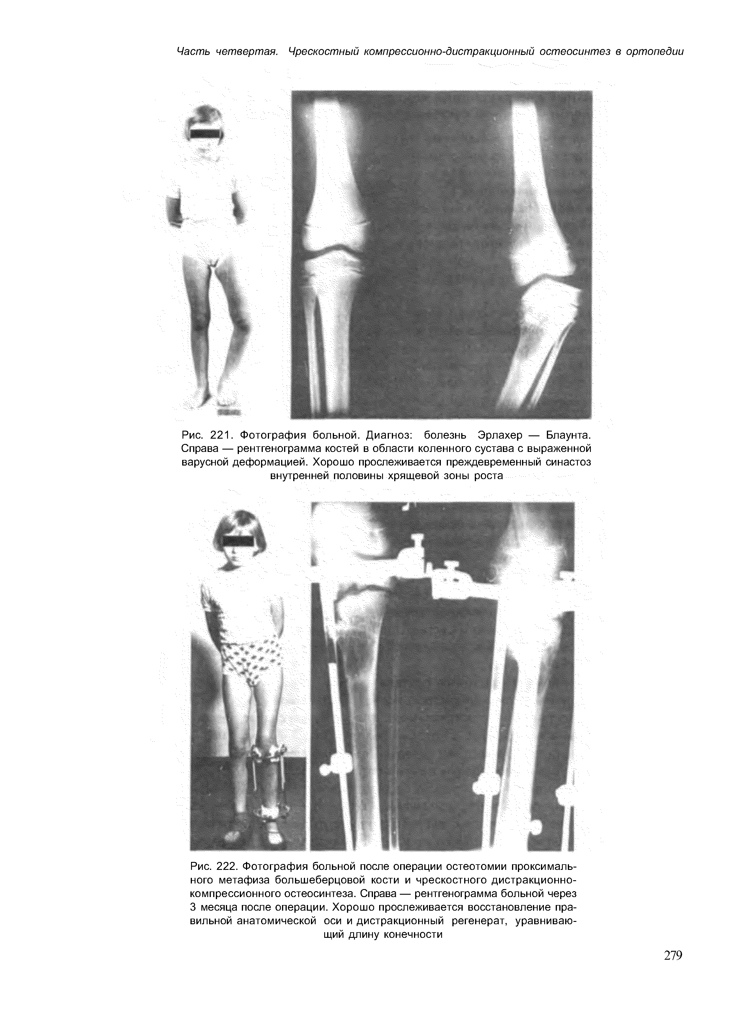 Рис. 222. Фотография больной после операции остеотомии проксимального метафиза большеберцовой кости и чрескостного дистракционнокомпрессионного остеосинтеза. Справа — рентгенограмма больной через 3 месяца после операции. Хорошо прослеживается восстановление правильной анатомической оси и дистракционный регенерат, уравнивающий длину конечности...