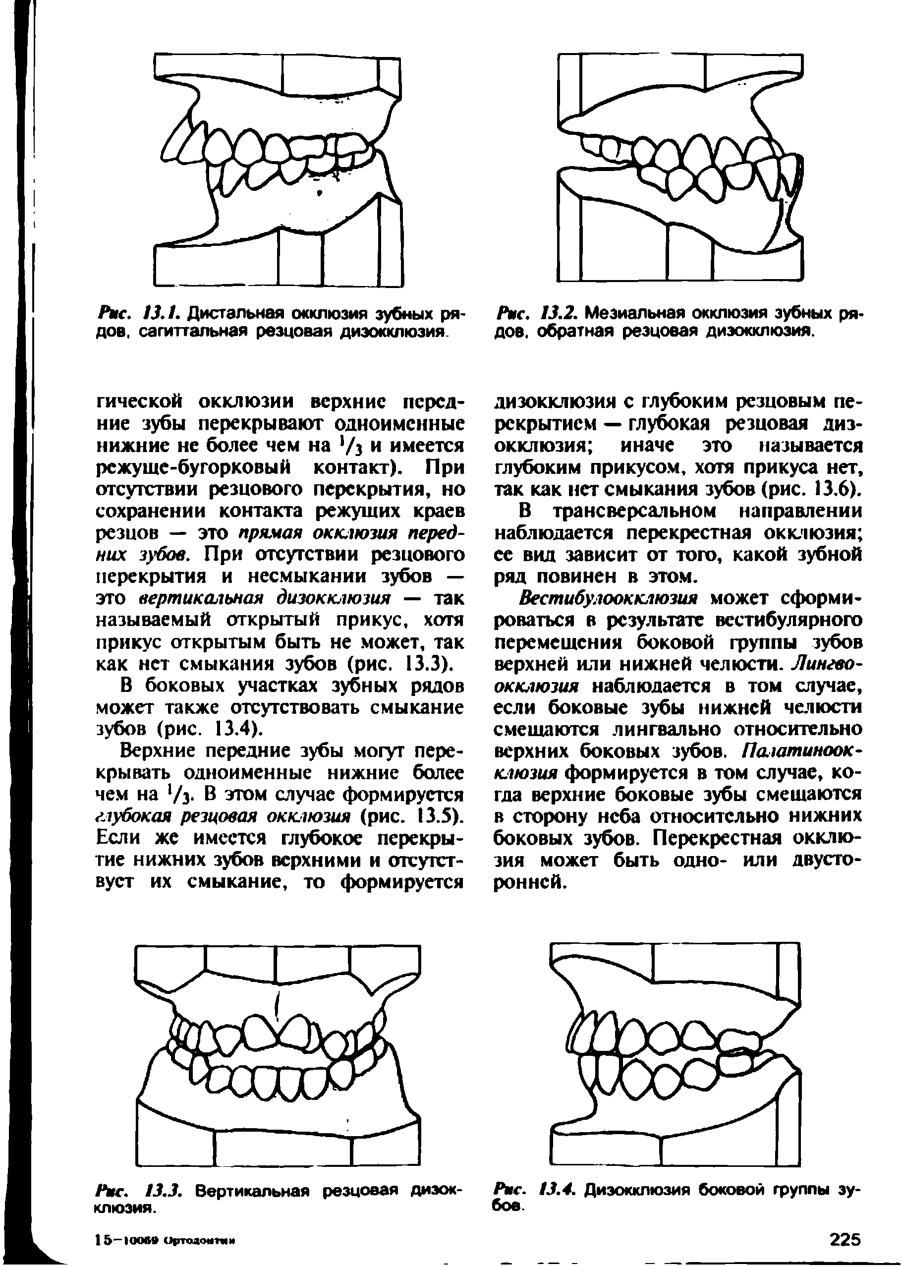 Рис. 13.2. Мезиальная окклюзия зубных рядов. обратная резцовая диэокклюзия.