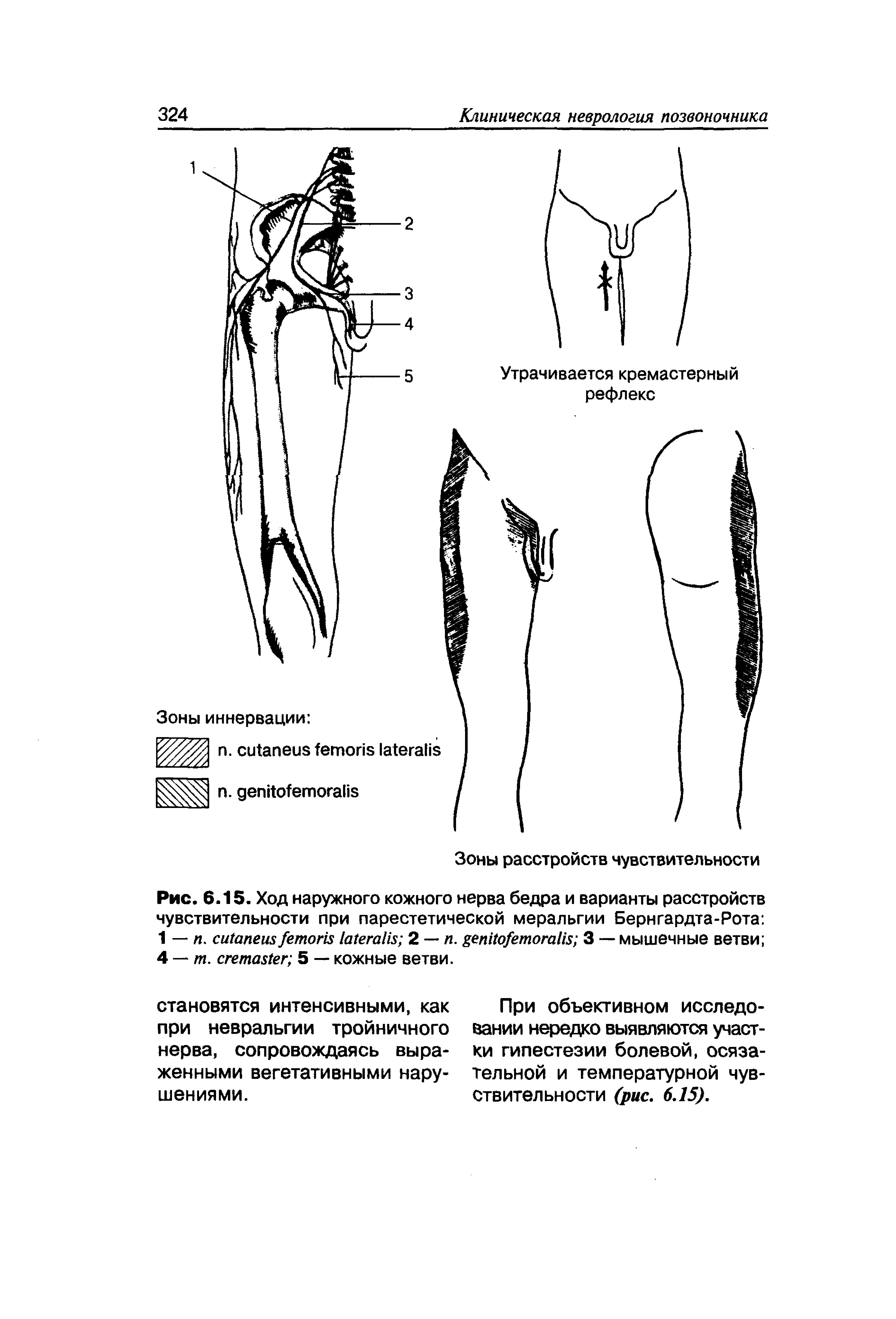 Рис. 6.15. Ход наружного кожного нерва бедра и варианты расстройств чувствительности при парестетической меральгии Бернгардта-Рота 1 — п. 2 — п. 3 — мышечные ветви 4 — т. 5 — кожные ветви.