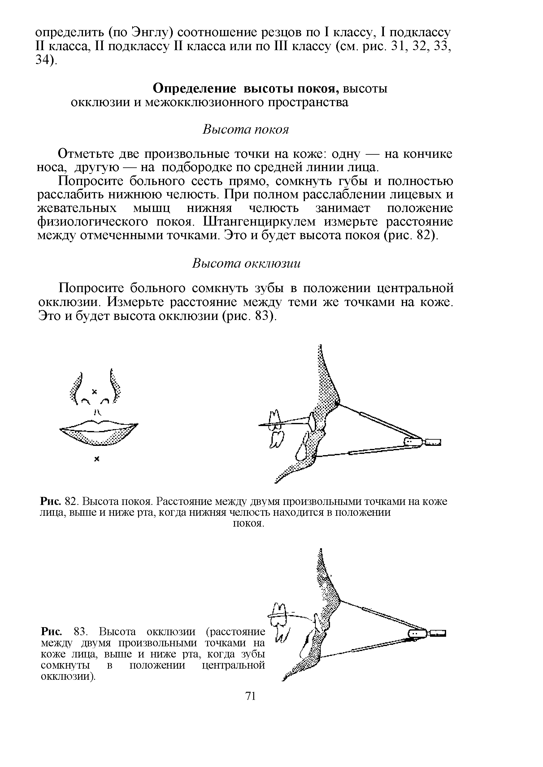 Рис. 82. Высота покоя. Расстояние между двумя произвольными точками на коже лица, выше и ниже рта, когда нижняя челюсть находится в положении...