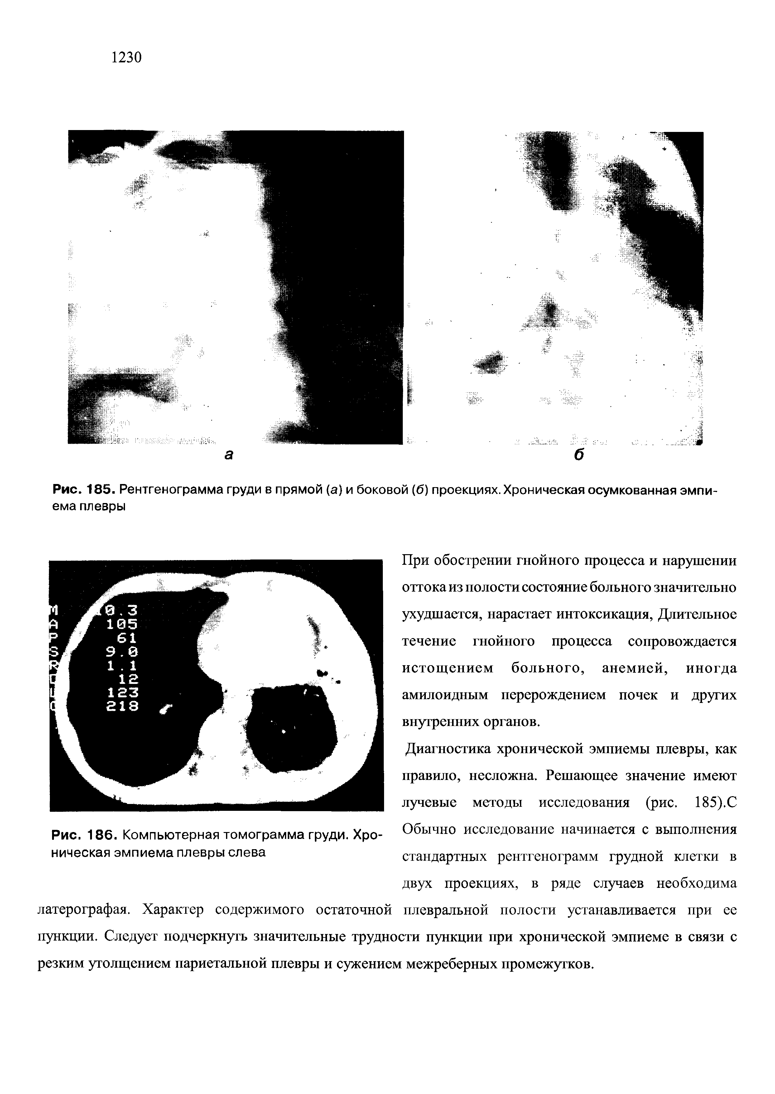 Рис. 186. Компьютерная томограмма груди. Хроническая эмпиема плевры слева...