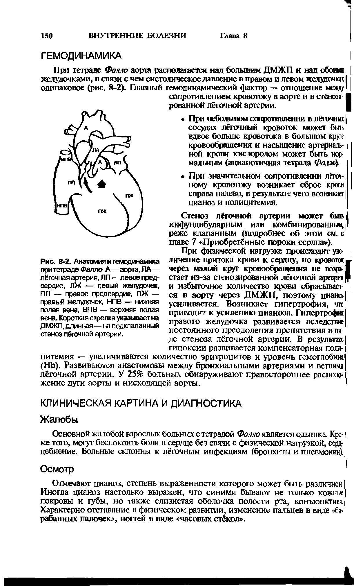 Рис. 8-2. Анатомия и гемодинамика при тетраде Фзппо А—аорта, ПА— лёгочная артерия, ЛП—левое предсердие, ЛЖ — левый желудочек. ПП — правое предсердие, ПЖ — правый желудочек, НПВ — нижняя полая вена. ВПВ — верхняя полая вена. Короткая стрелка указывает на ДМЖП, длинная — на подклапанный стеноз лёгочной артерии.