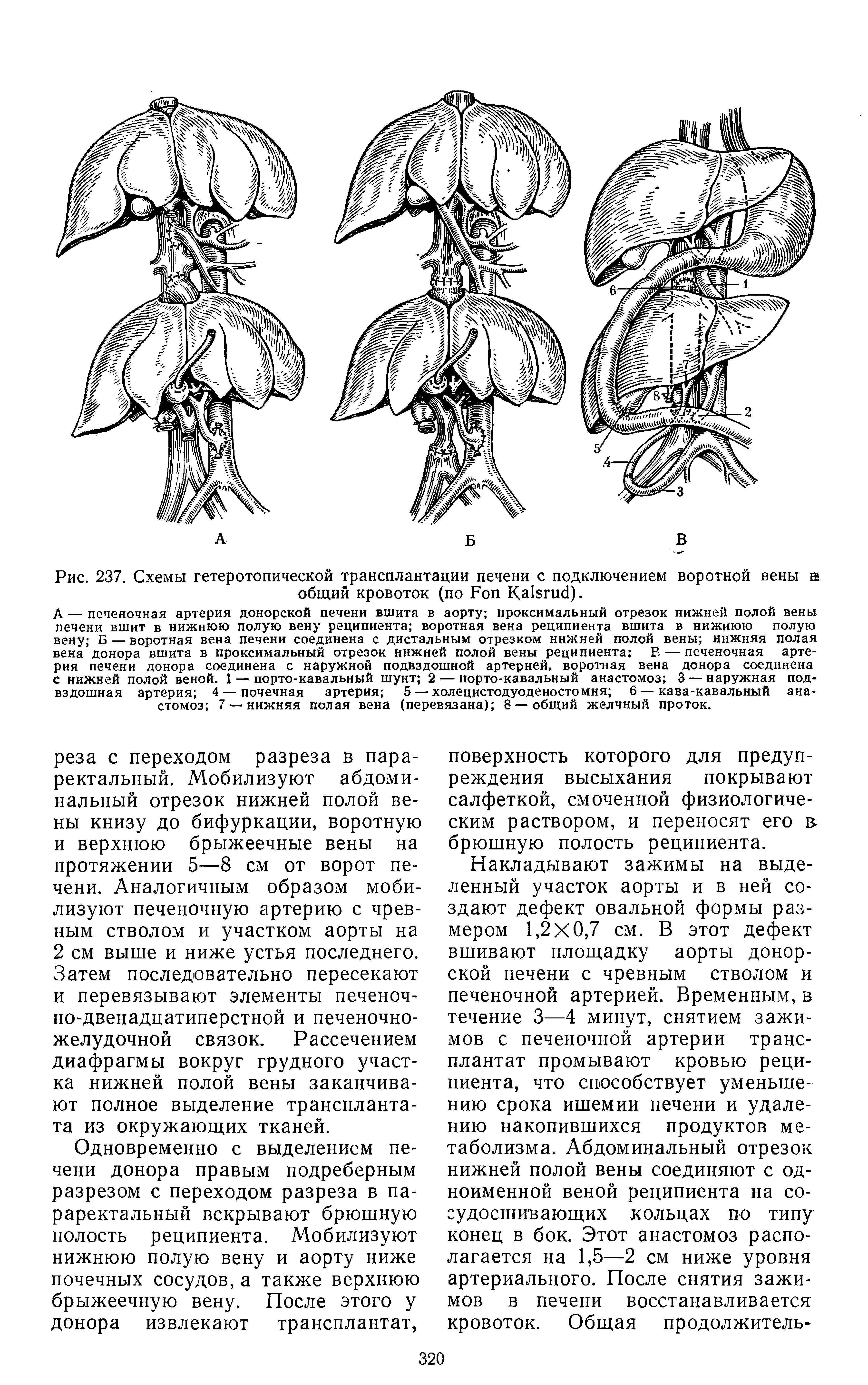 Рис. 237. Схемы гетеротопической трансплантации печени с подключением воротной вены в общий кровоток (по F K ).