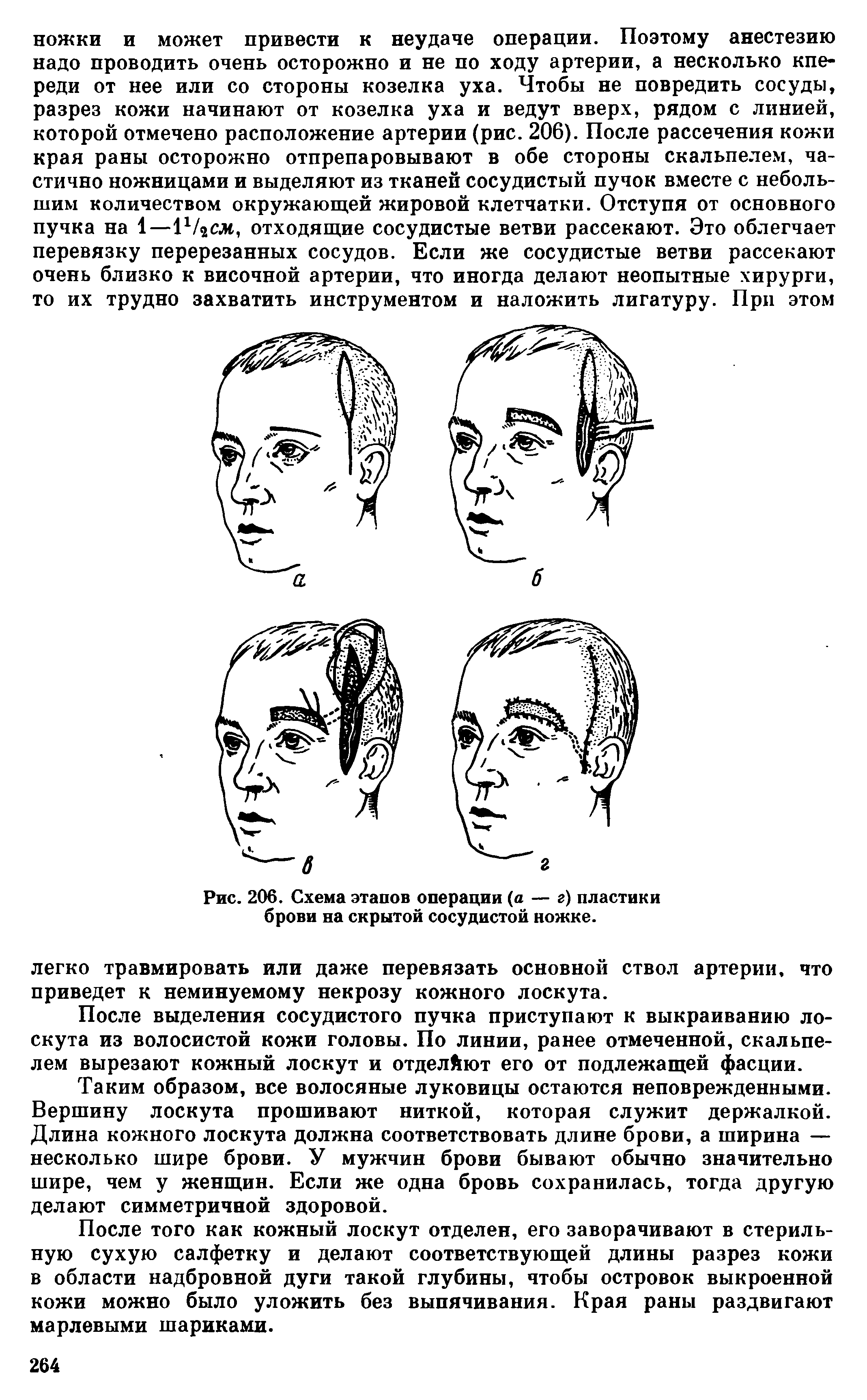 Рис. 206. Схема этапов операции (а — г) пластики брови на скрытой сосудистой ножке.