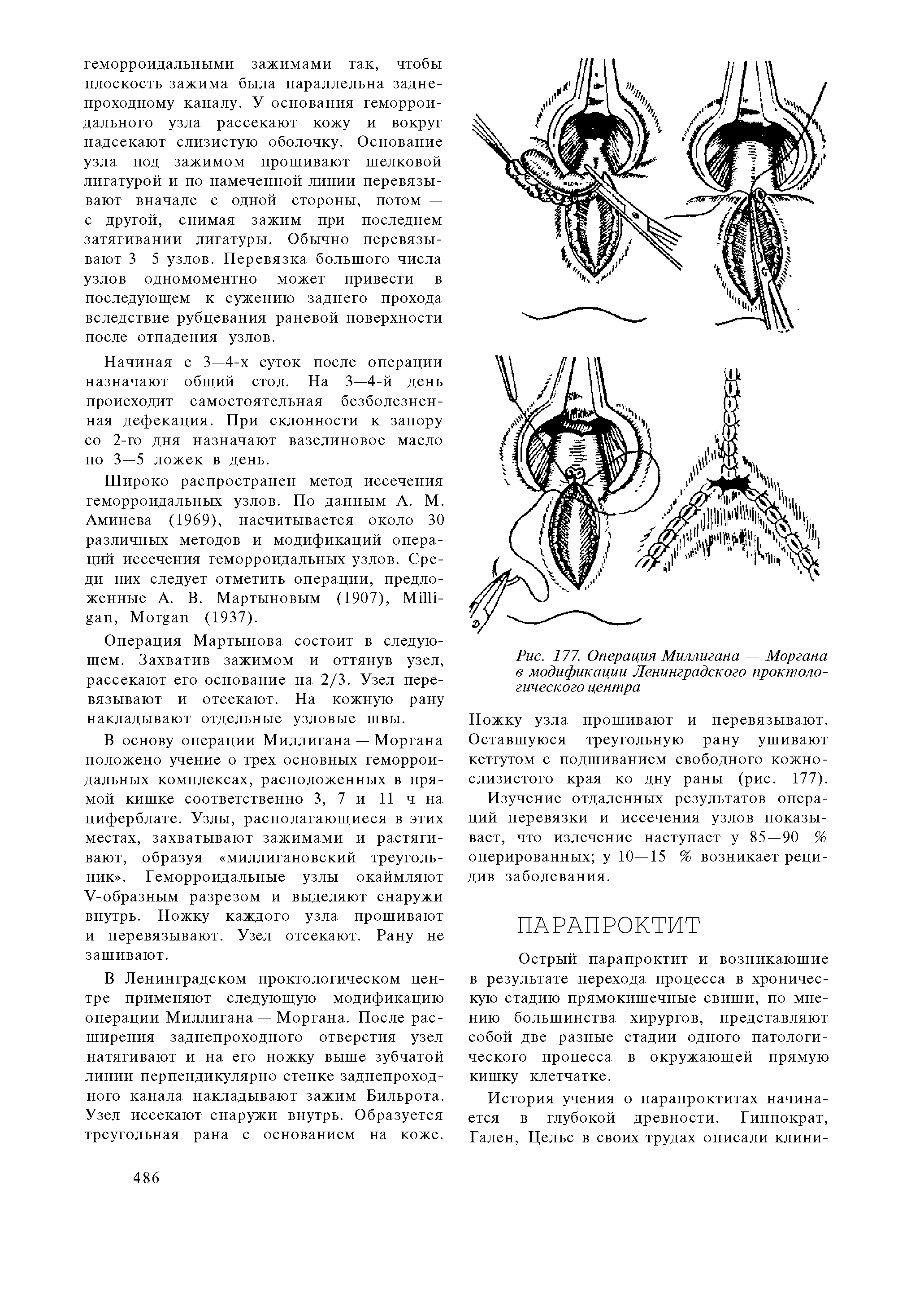 Рис. 177. Операция Миллигана — Моргана в модификации Ленинградского проктологического центра...