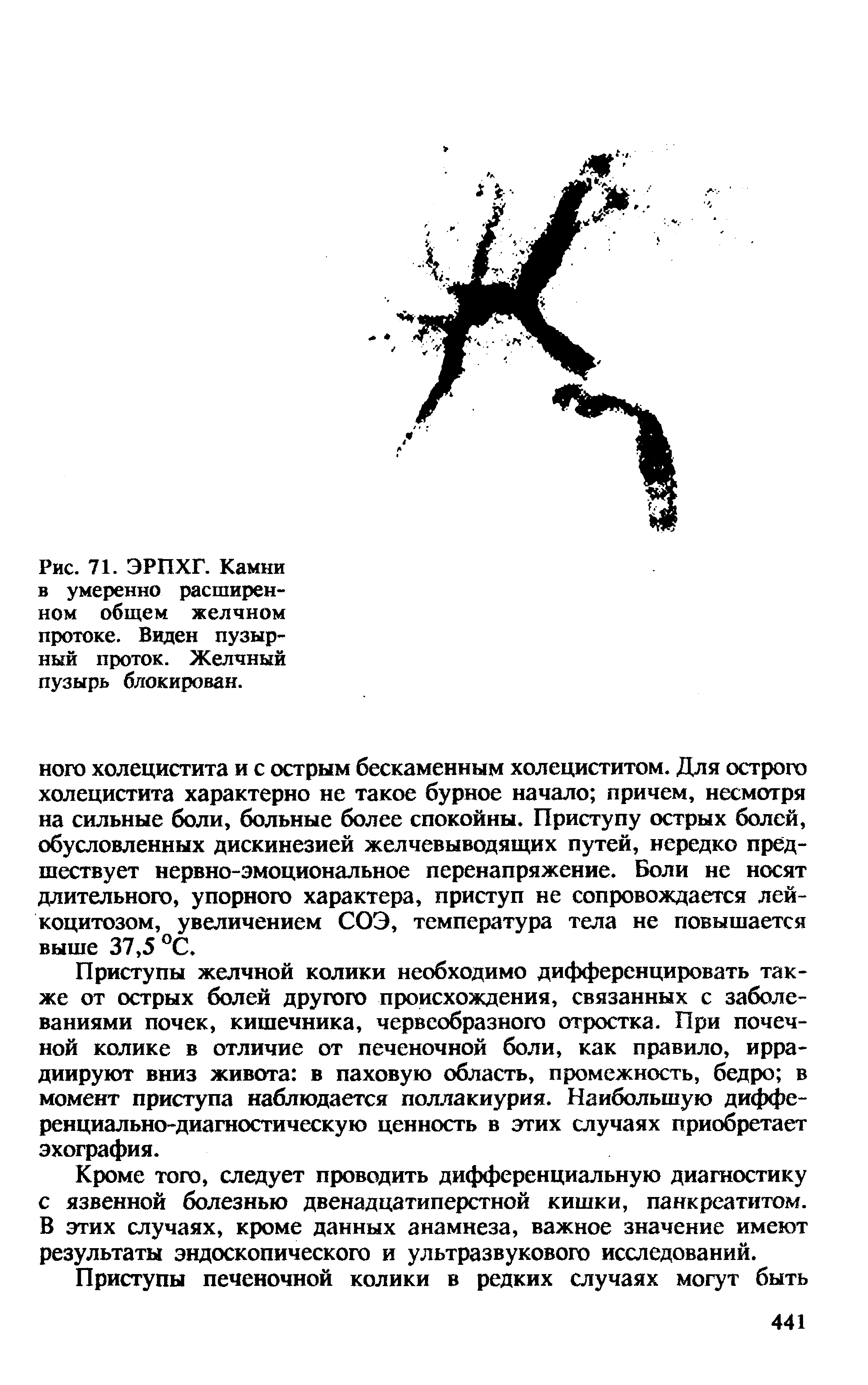 Рис. 71. ЭРПХГ. Камни в умеренно расширенном общем желчном протоке. Виден пузырный проток. Желчный пузырь блокирован.