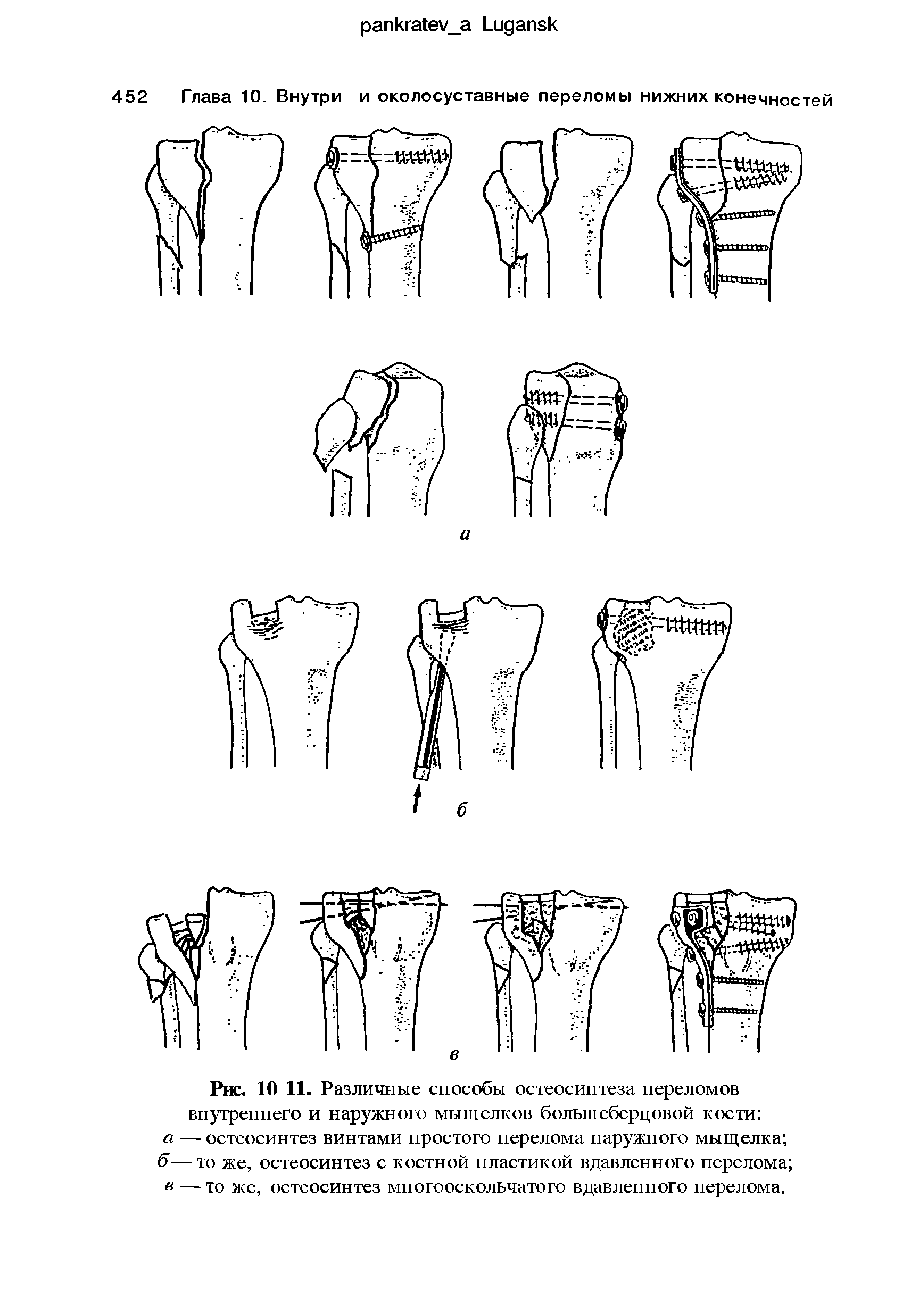 Рис. 10 11. Различные способы остеосинтеза переломов внутреннего и наружного мыщелков большеберцовой кости а — остеосинтез винтами простого перелома наружного мыщелка б—то же, остеосинтез с костной пластикой вдавленного перелома в —то же, остеосинтез многооскольчатого вдавленного перелома.