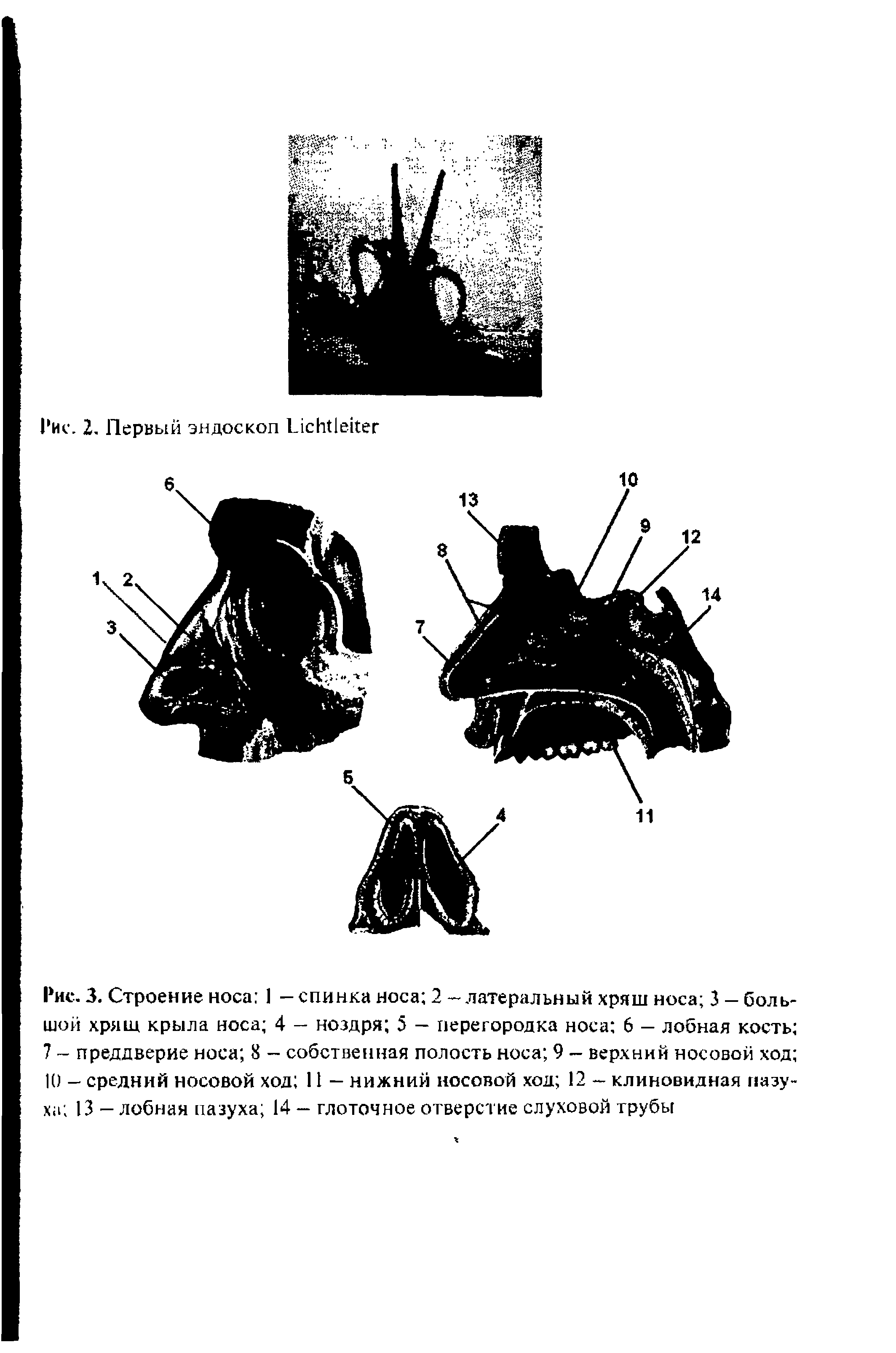 Рис. 3. Строение носа 1 - спинка носа 2 - латеральный хряш носа 3 - большой хрящ крыла носа 4 — ноздря 5 — перегородка носа 6 — лобная кость 7 - преддверие носа 8 - собственная полость носа 9 — верхний носовой ход К) - средний носовой ход 11 — нижний носовой ход 12 - клиновидная пазуха 13 - лобная пазуха 14 - глоточное отверстие слуховой трубы...