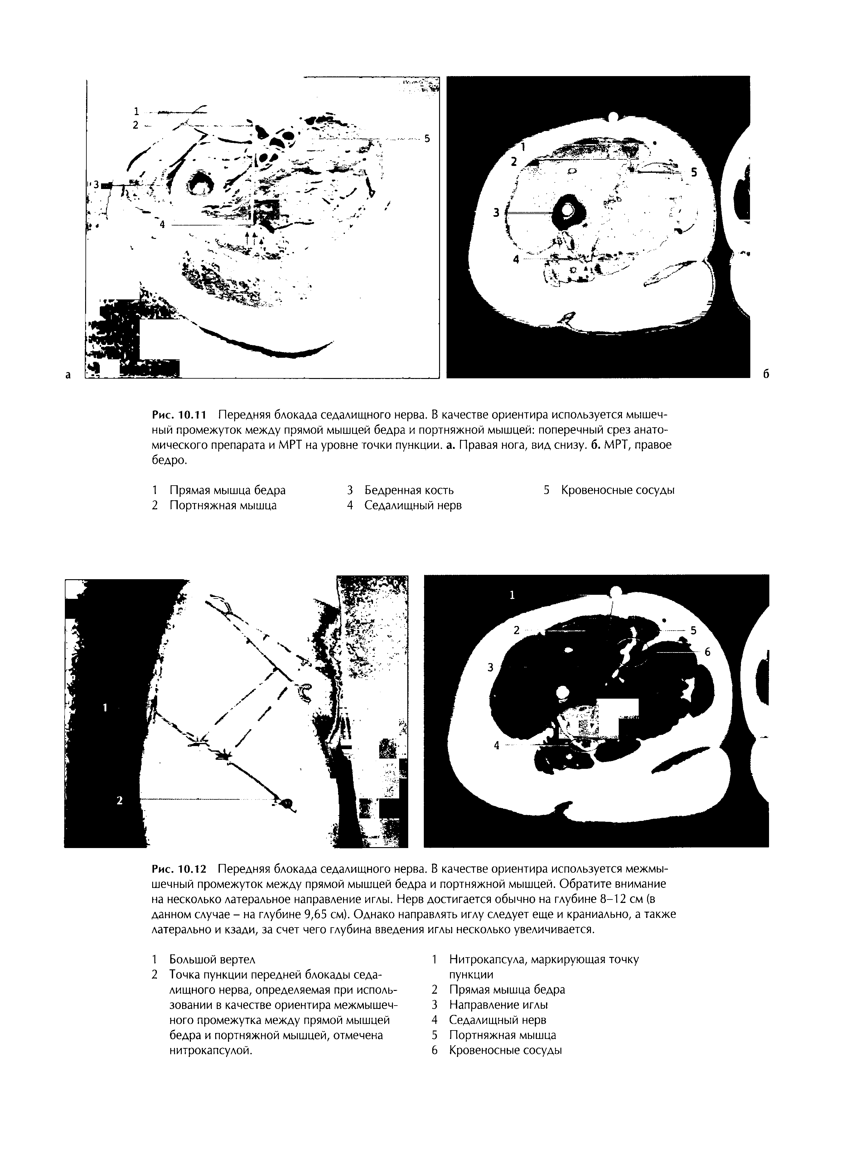 Рис. 10.11 Передняя блокада седалищного нерва. В качестве ориентира используется мышечный промежуток между прямой мышцей бедра и портняжной мышцей поперечный срез анатомического препарата и МРТ на уровне точки пункции, а. Правая нога, вид снизу, б. МРТ, правое бедро.