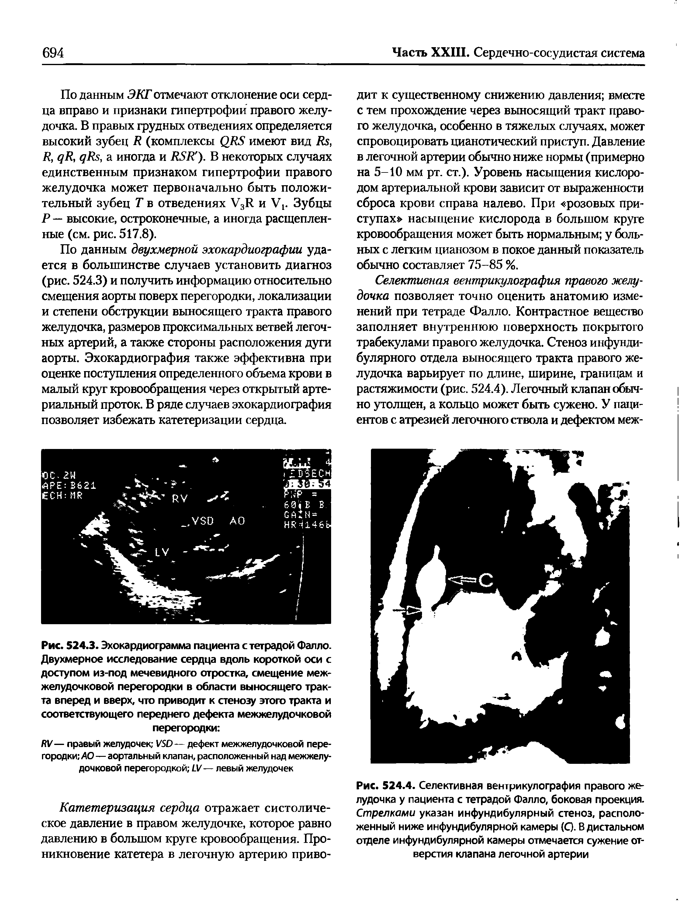Рис. 524.4. Селективная вентрикулография правого желудочка у пациента с тетрадой Фалло, боковая проекция. Стрелками указан инфундибулярный стеноз, расположенный ниже инфундибулярной камеры (С). В дистальном отделе инфундибулярной камеры отмечается сужение отверстия клапана легочной артерии...