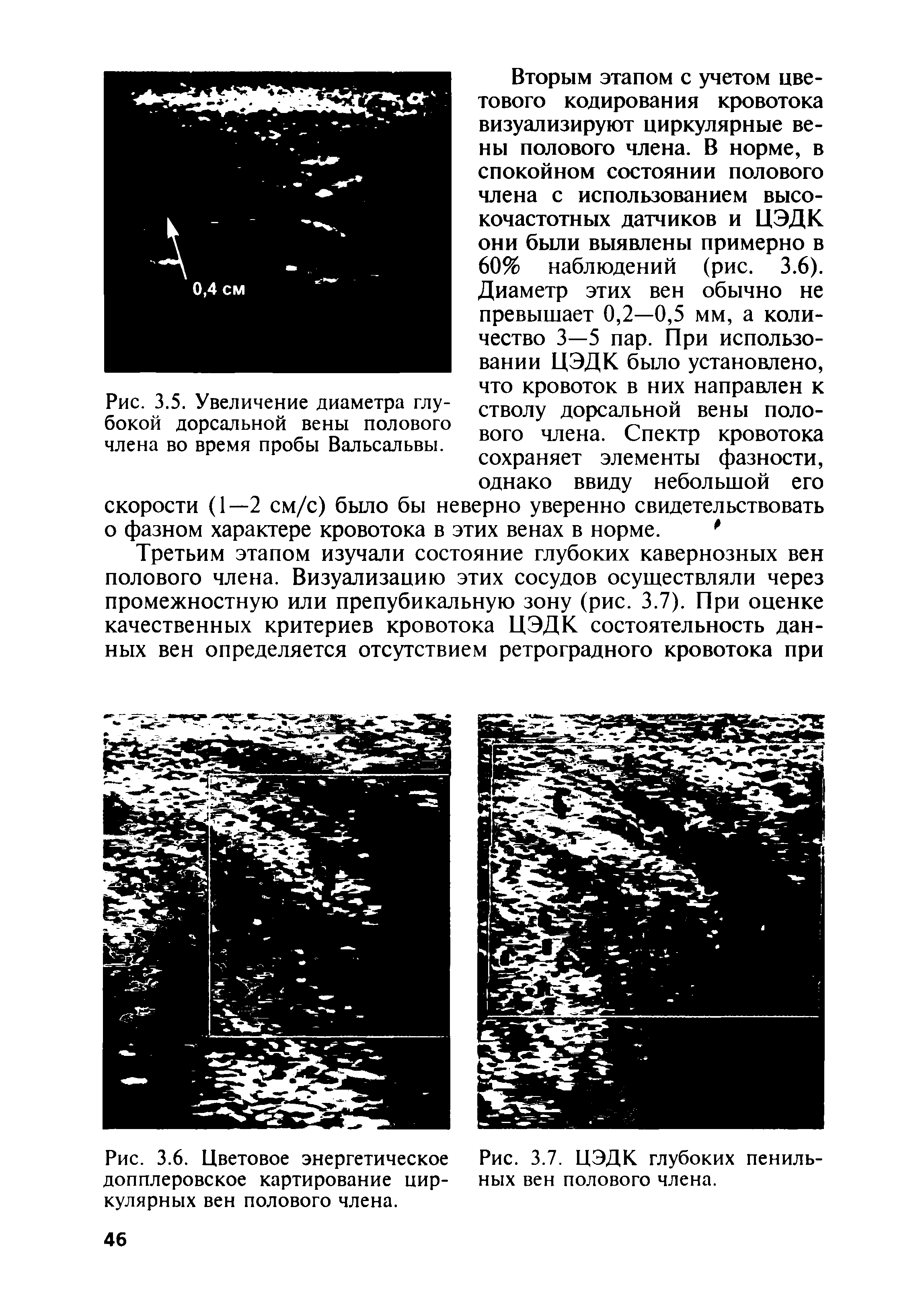 Рис. 3.6. Цветовое энергетическое допплеровское картирование циркулярных вен полового члена.