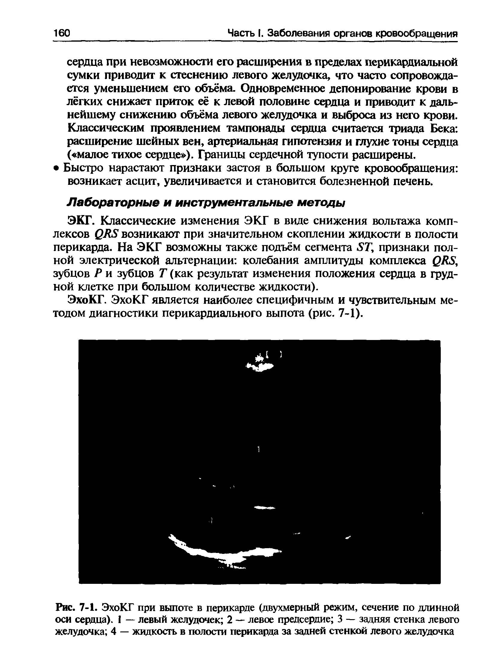 Рис. 7-1. ЭхоКГ при выпоте в перикарде (двухмерный режим, сечение по длинной оси сердца). 1 — левый желудочек 2 — левое предсердие 3 — задняя стенка левого желудочка 4 — жидкость в полости перикарда за задней стенкой левого желудочка...