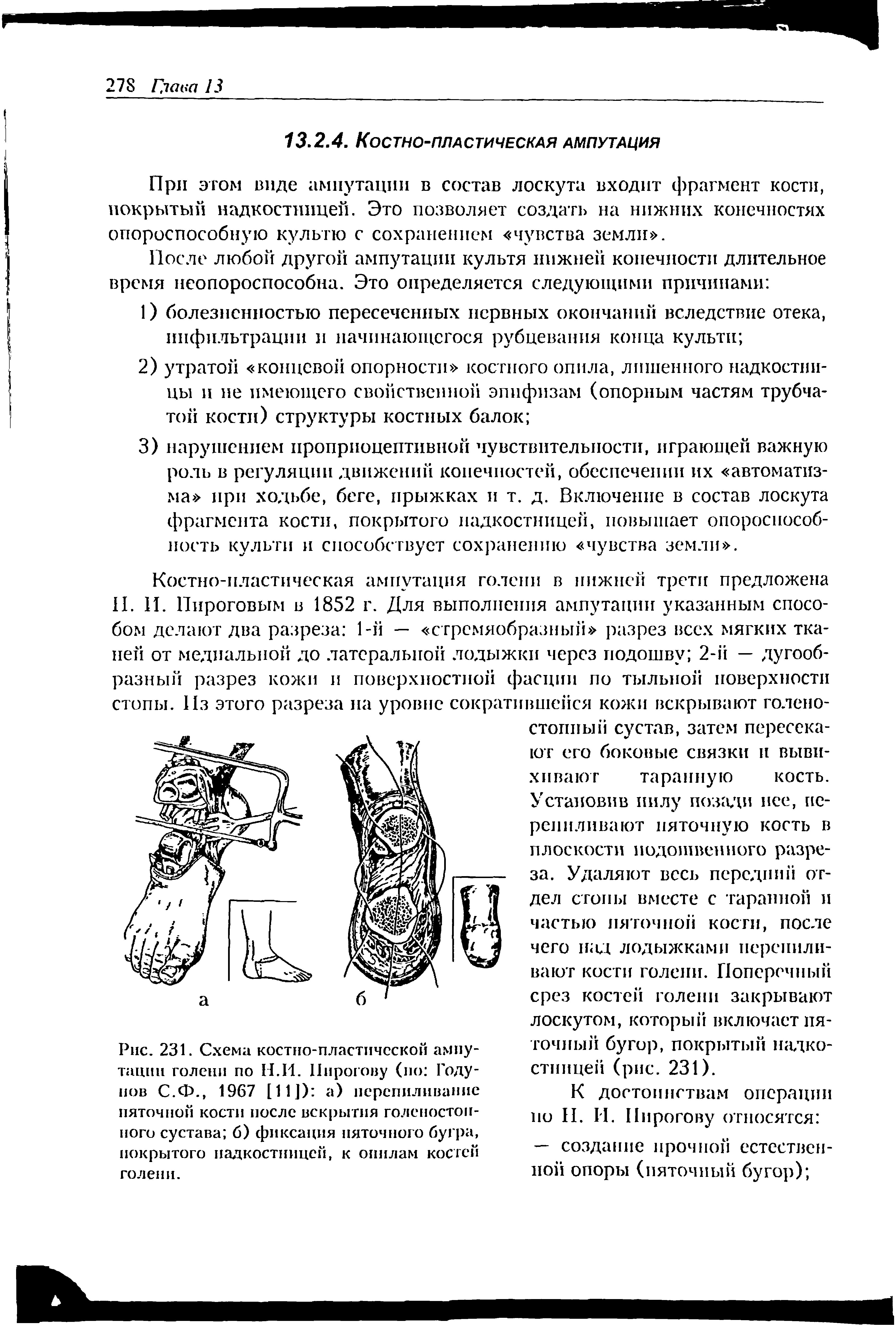 Рис. 231. Схема костно-пластической ампутации голени по Н.И. Пирогову (по Годунов С.Ф., 1967 [11]) а) перепиливание пяточной кости после вскрытия голеностопного сустава б) фиксация пяточного бугра, покрытого надкостницей, к опилам кос гей голени.