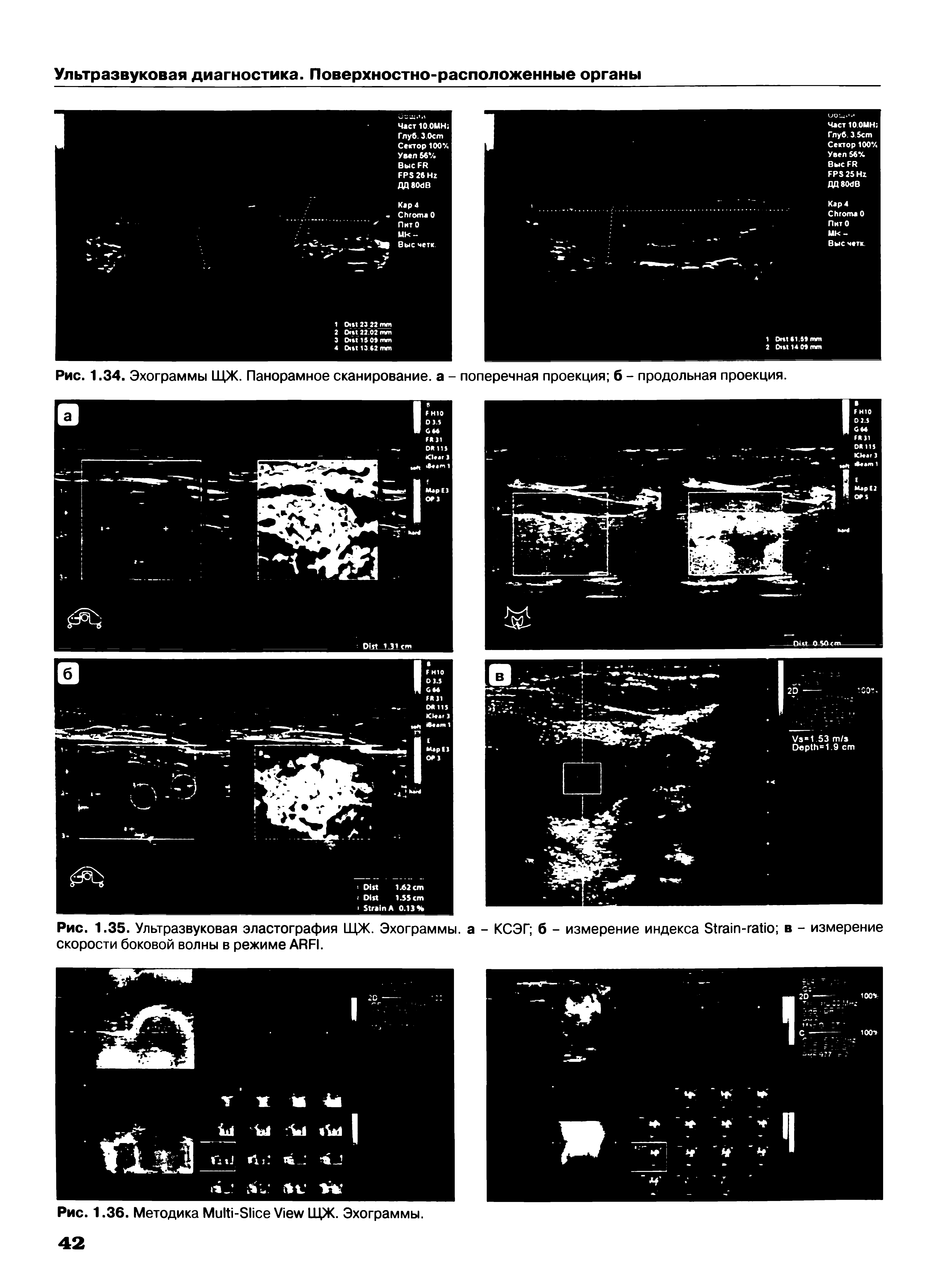 Рис. 1.35. Ультразвуковая эластография ЩЖ. Эхограммы, а - КСЭГ б - измерение индекса S - в - измерение скорости боковой волны в режиме ARFI.