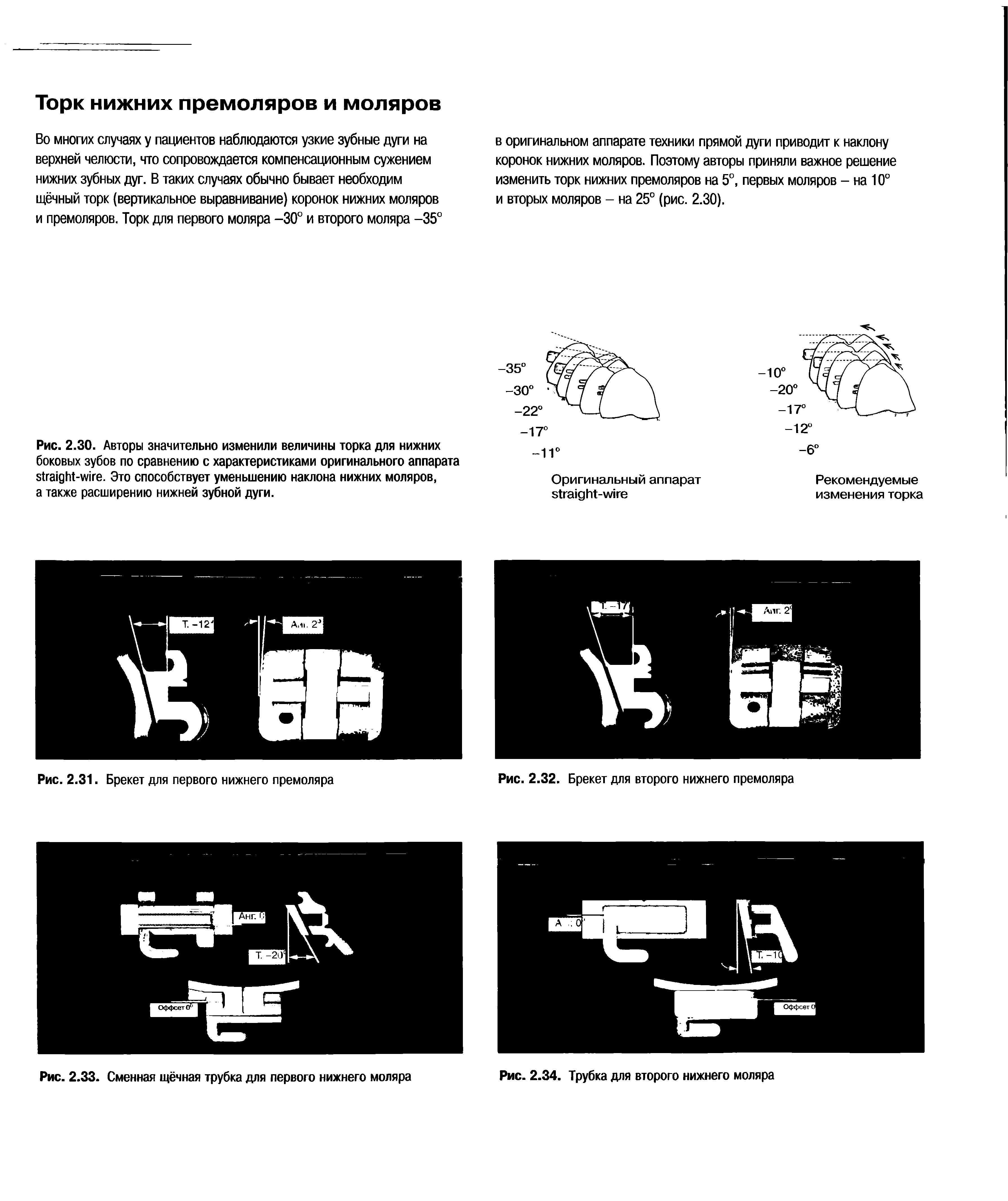 Рис. 2.30. Авторы значительно изменили величины торка для нижних боковых зубов по сравнению с характеристиками оригинального аппарата - . Это способствует уменьшению наклона нижних моляров, а также расширению нижней зубной дуги.