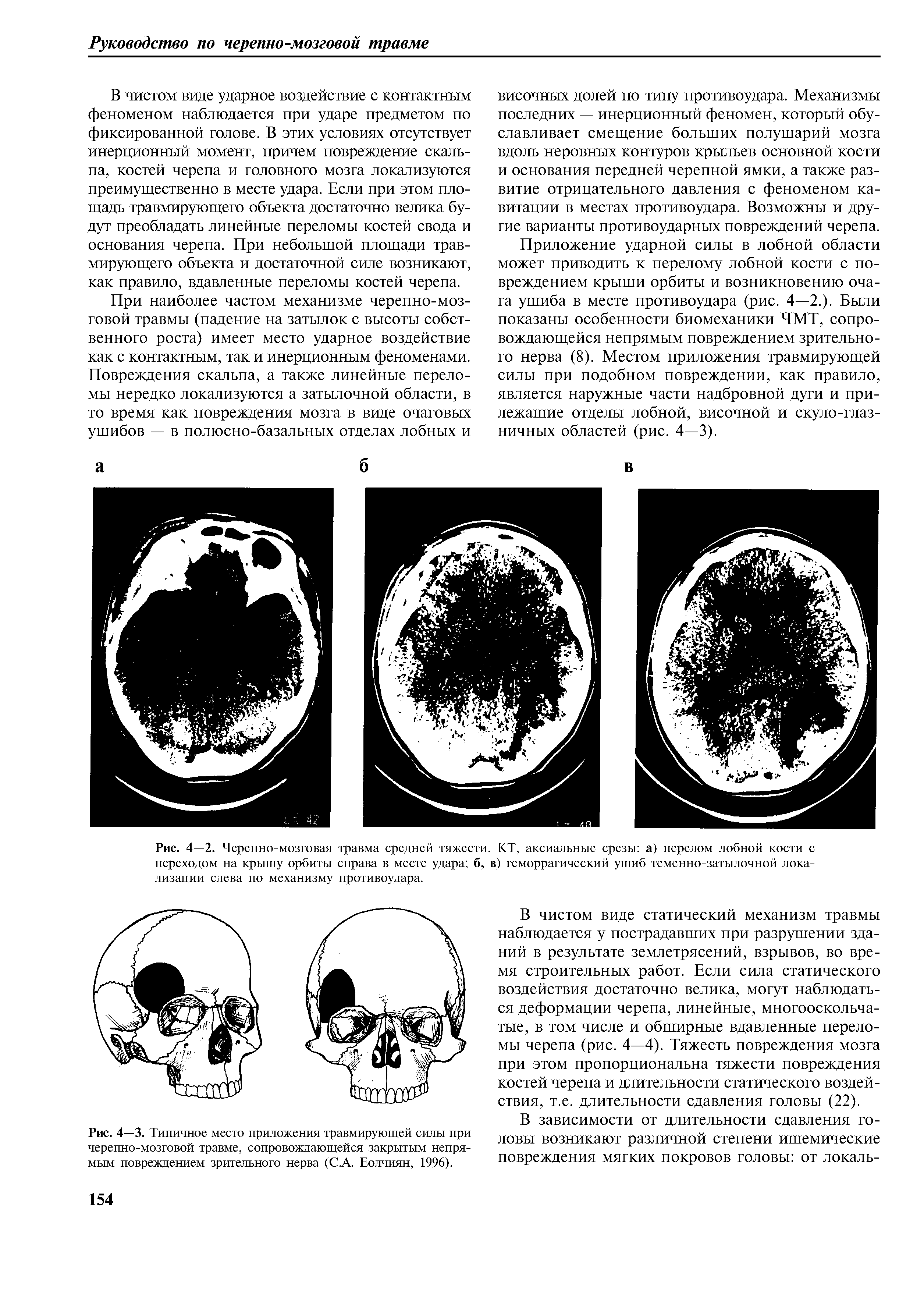Рис. 4—3. Типичное место приложения травмирующей силы при черепно-мозговой травме, сопровождающейся закрытым непрямым повреждением зрительного нерва (С.А. Еолчиян, 1996).