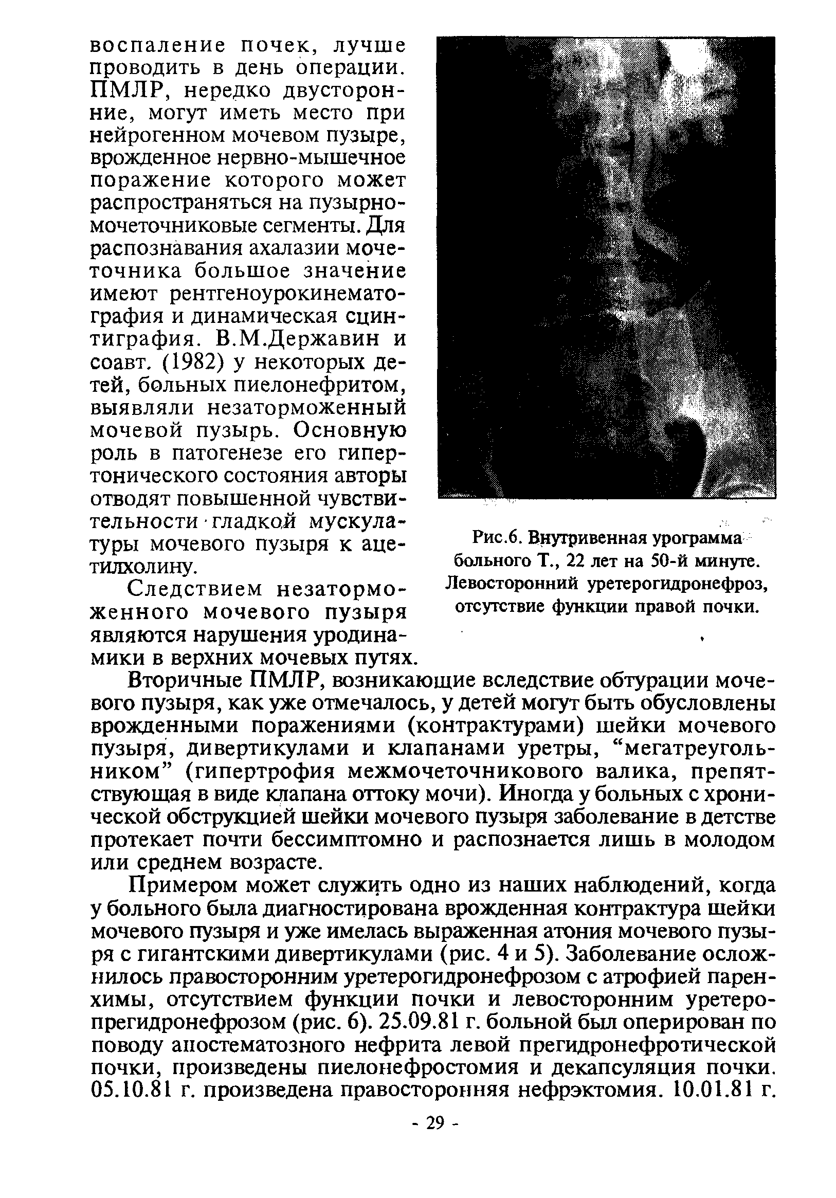 Рис.6. Внутривенная урограмма больного Т., 22 лет на 50-й минуте. Левосторонний уретерогидронефроз, отсутствие функции правой почки.