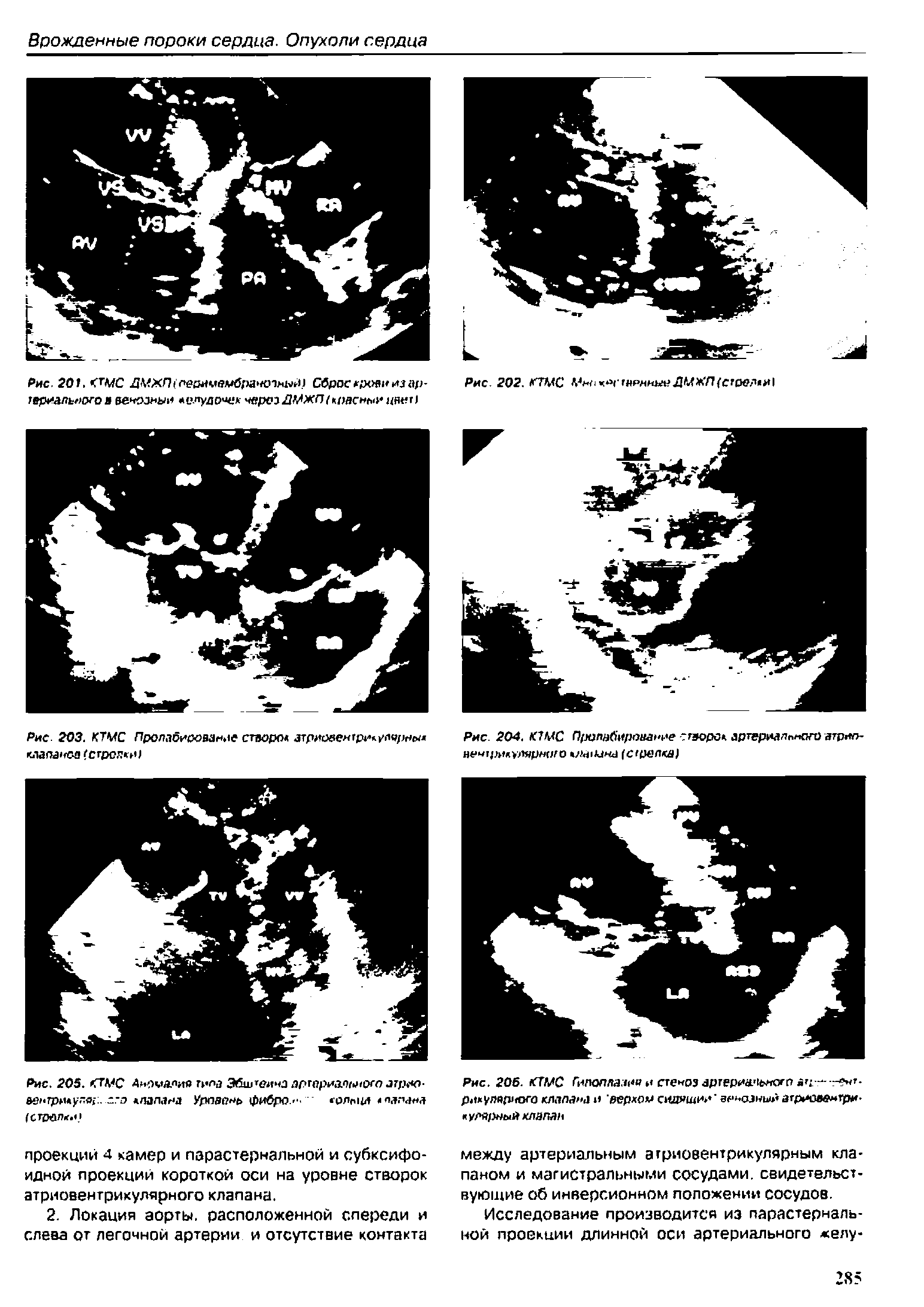 Рис. 206. КТМС Гипоплазия и стеноз артериального ач-— -рнкуляриого клапана и верхом сидяшии венозный атриментри-кулярный клзпап...