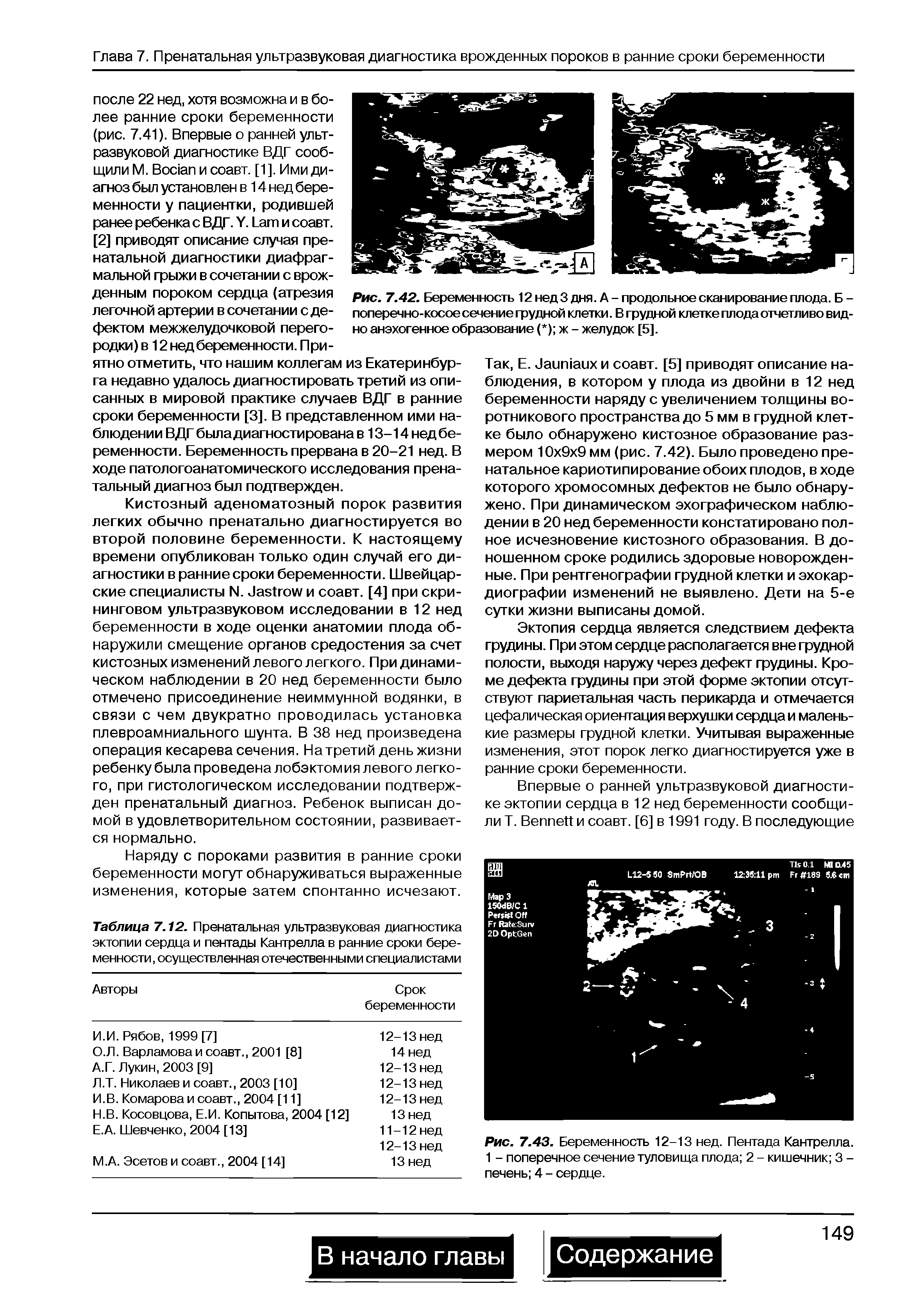 Рис. 7.43. Беременность 12-13 нед. Пентада Кантрелла. 1 - поперечное сечение туловища плода 2 - кишечник 3 -печень 4 - сердце.