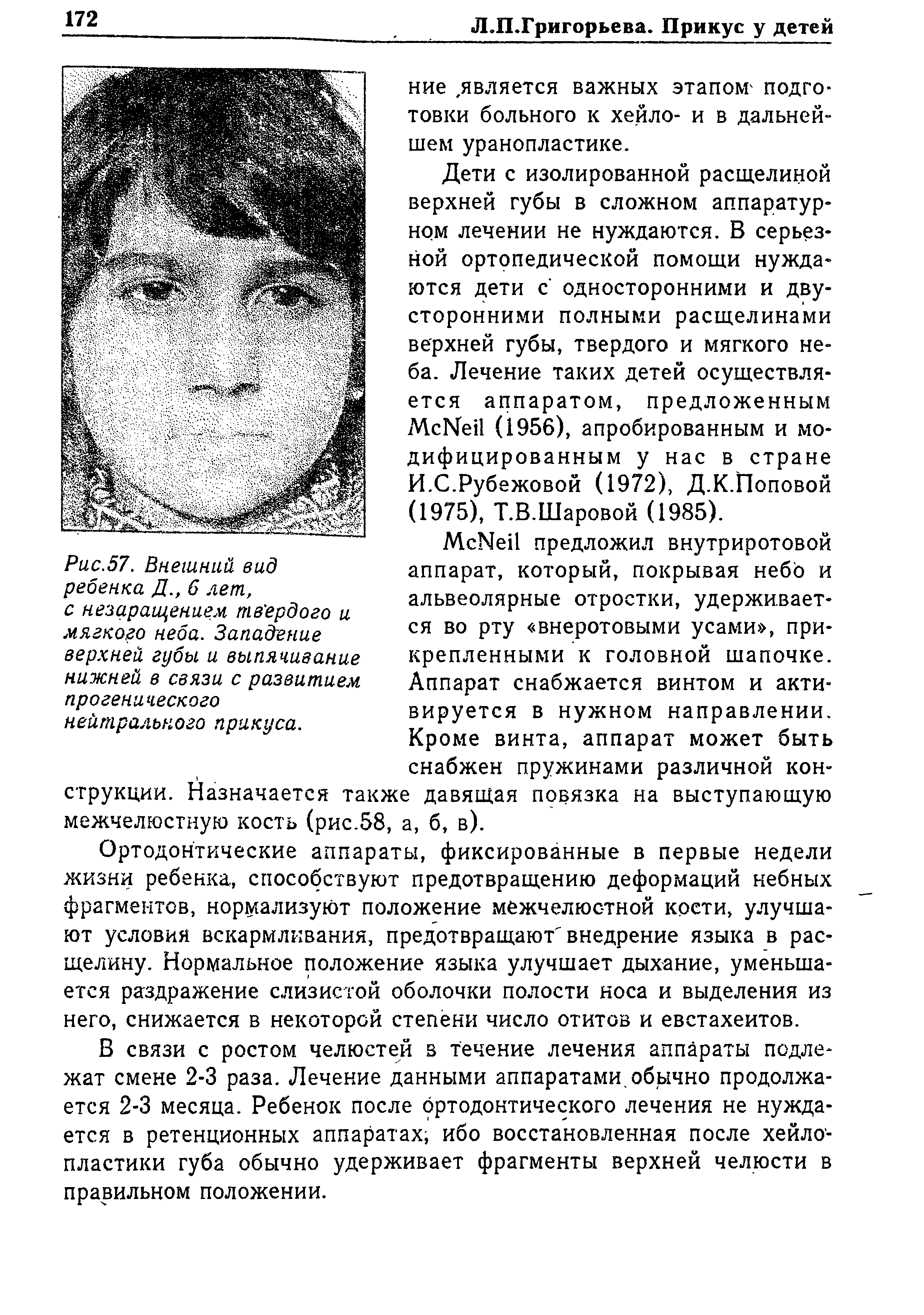 Рис.57. Внешний вид ребенка Д., 6 лет, с незаращением твердого и мягкого неба. Западение верхней губы и выпячивание нижней в связи с развитием прогенического нейтрального прикуса.