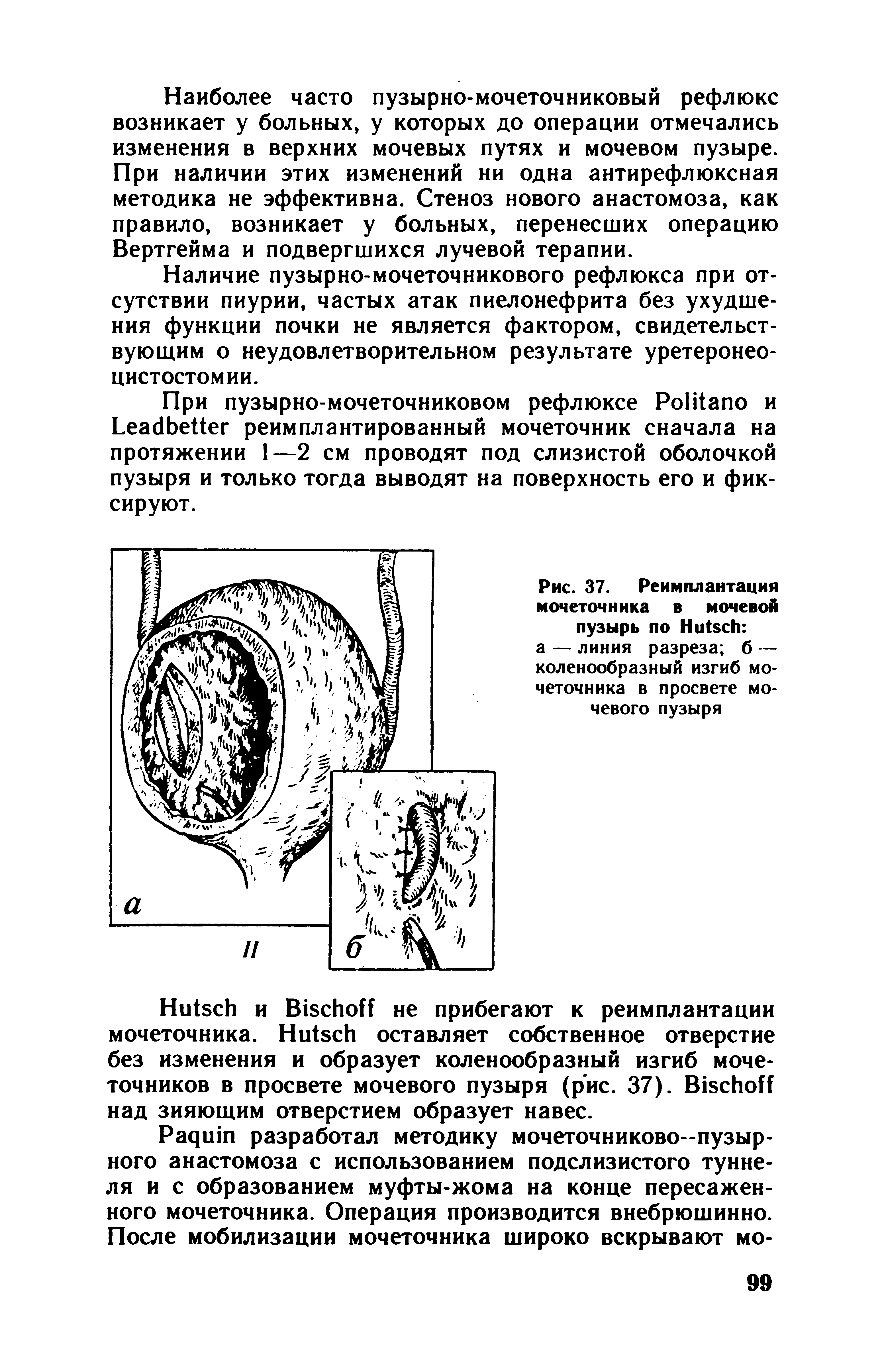 Рис. 37. Реимплантация мочеточника в мочевой пузырь по H а — линия разреза б — коленообразный изгиб мочеточника в просвете мочевого пузыря...