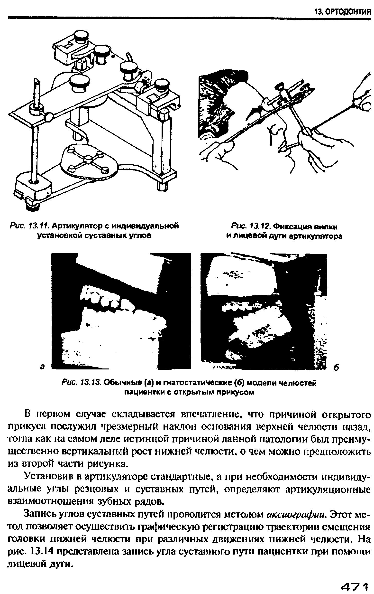 Рис. 13.13. Обычные (а) и гнатостатические (б) модели челюстей пациентки с открытым прикусом...