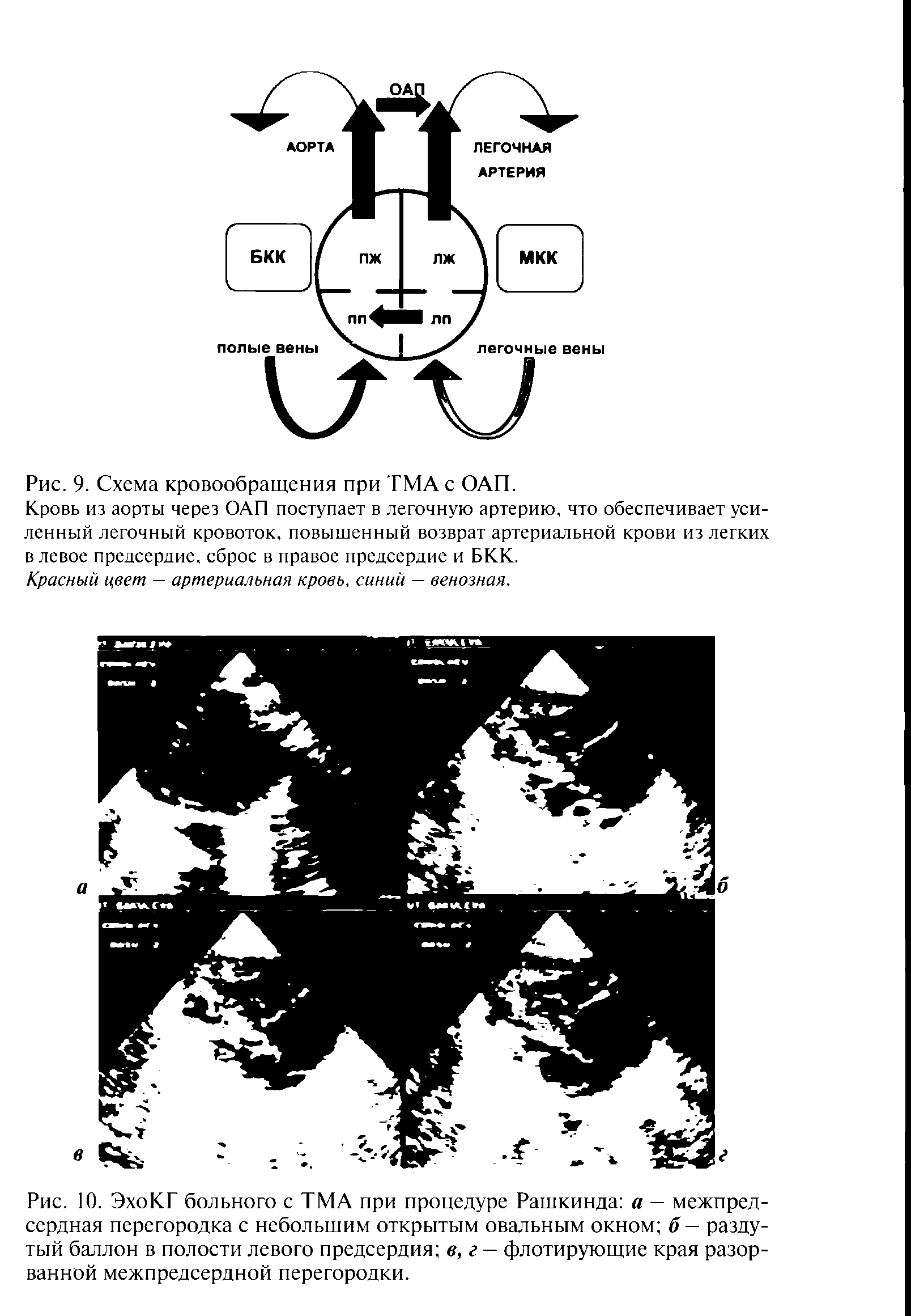 Рис. 10. ЭхоКГ больного с ТМА при процедуре Рашкинда а — межпредсердная перегородка с небольшим открытым овальным окном б — раздутый баллон в полости левого предсердия в, г — флотирующие края разорванной межпредсердной перегородки.