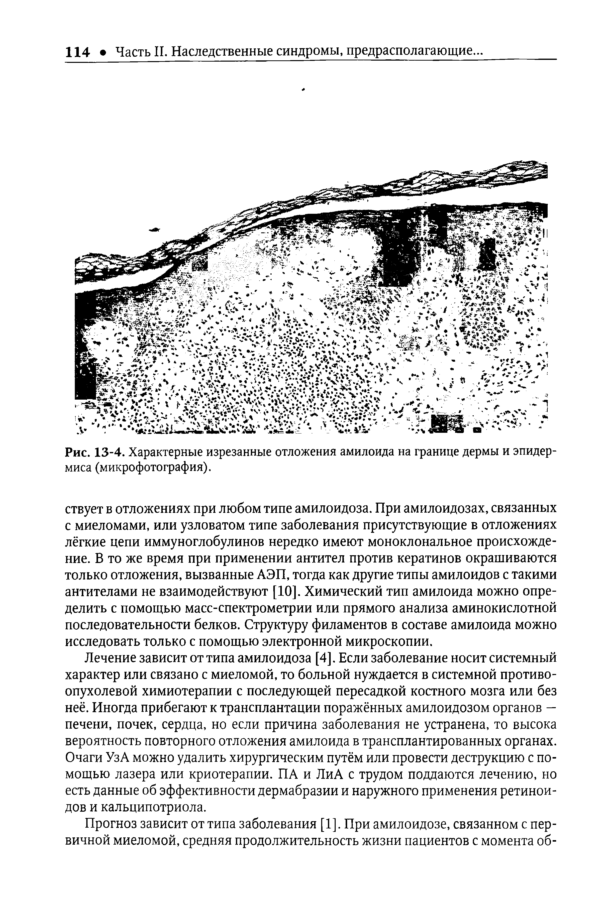 Рис. 13-4. Характерные изрезанные отложения амилоида на границе дермы и эпидермиса (микрофотография).