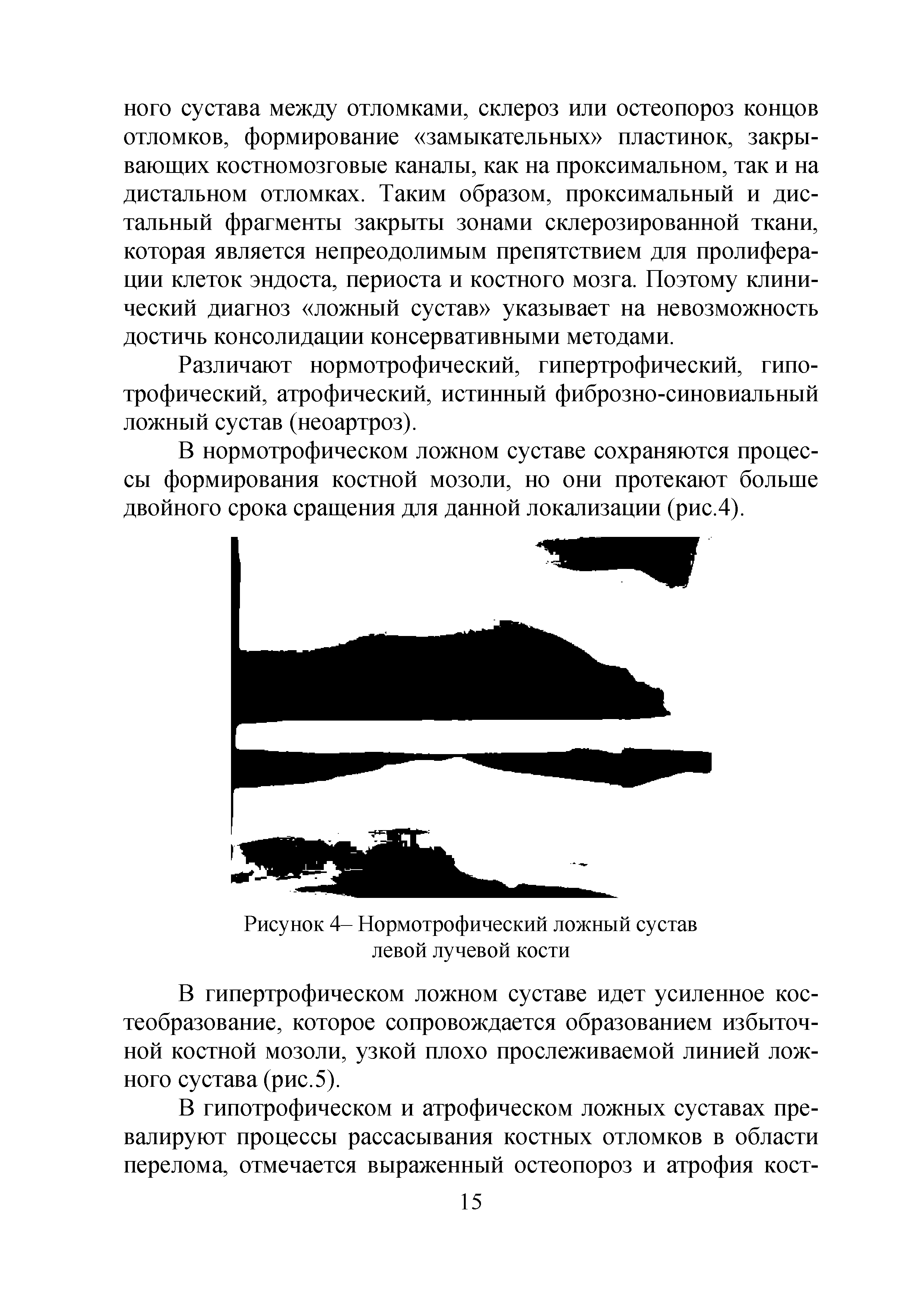 Рисунок 4- Нормотрофический ложный сустав левой лучевой кости...