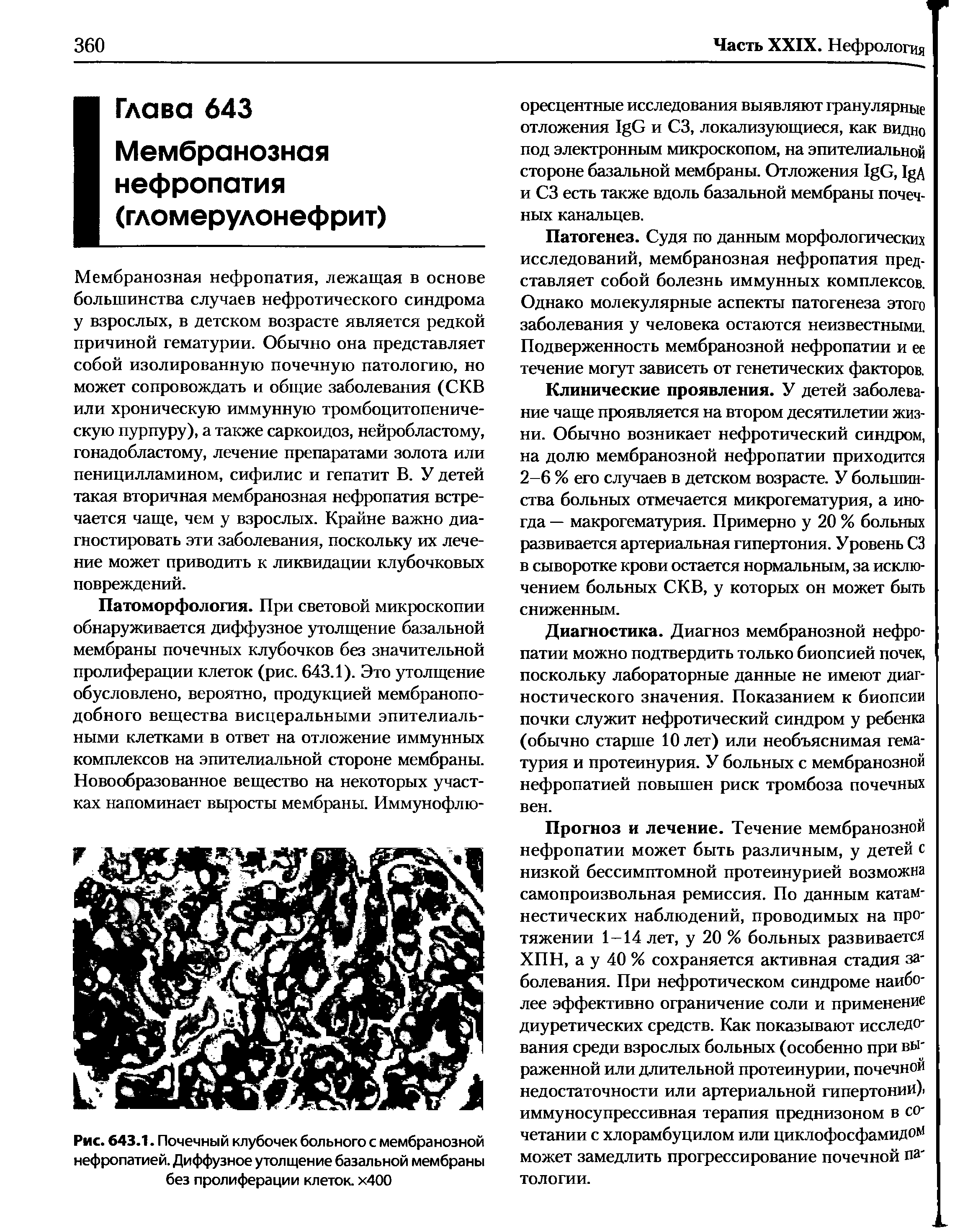 Рис. 643.1. Почечный клубочек больного с мембранозной нефропатией. Диффузное утолщение базальной мембраны без пролиферации клеток. х400...