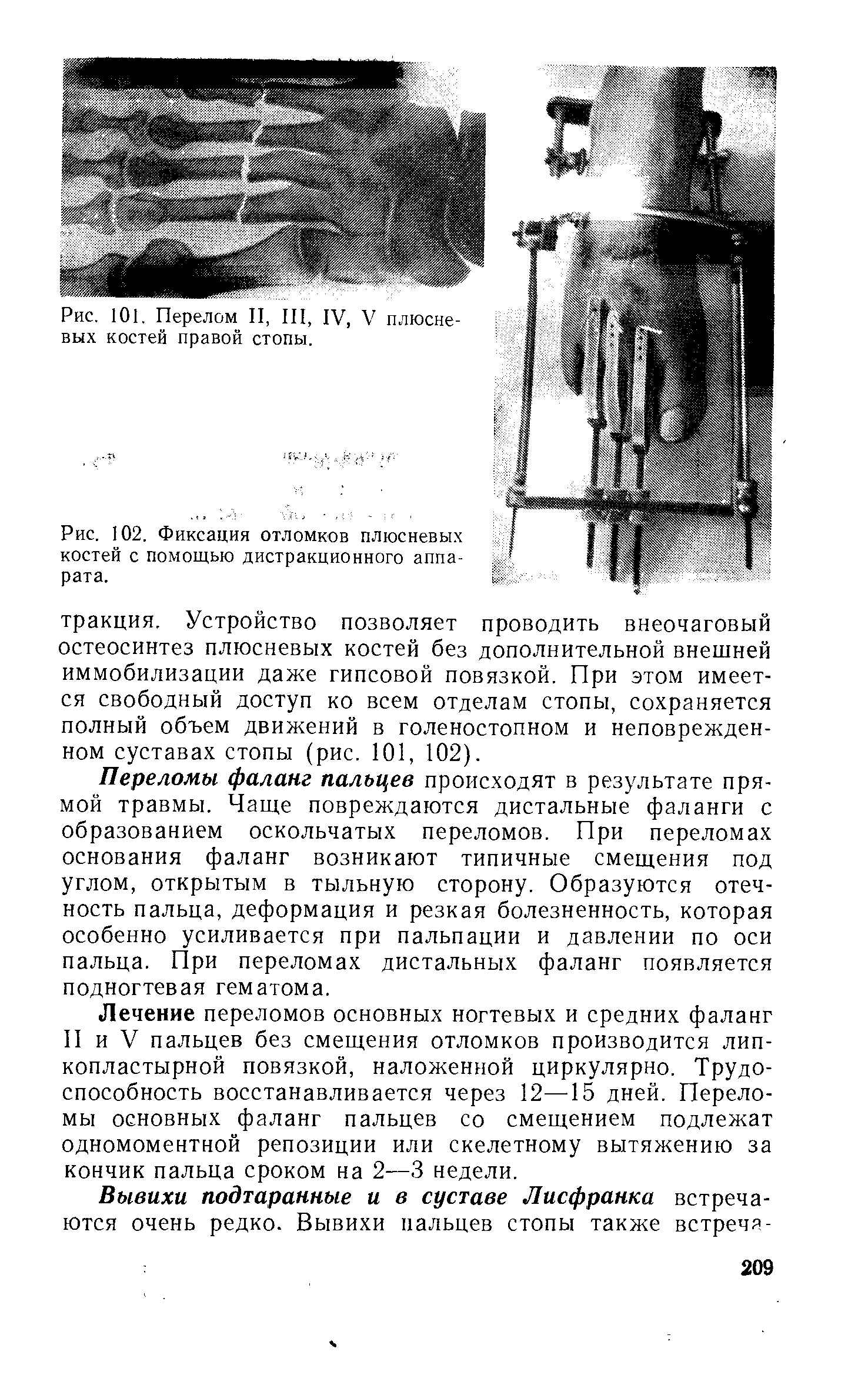 Рис. 102. Фиксация отломков плюсневых костей с помощью дистракционного аппарата.