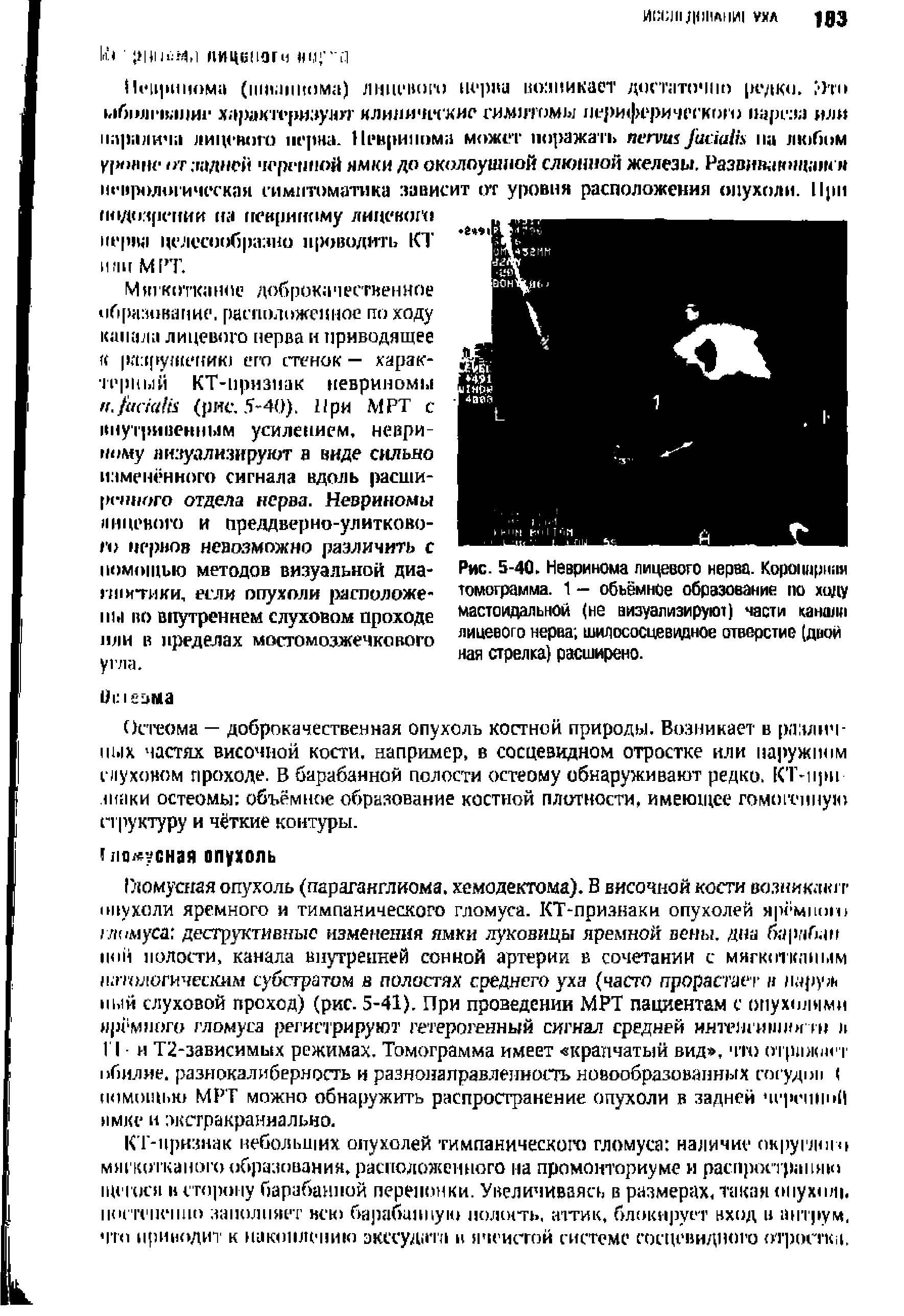 Рис. 5-40. Невринома лицевого нерва. Коронарная томограмма. 1 — объёмное образование по ходу мастоидальной (не визуализируют) части канала лицевого нерва шилососцевидное отверстие (двои ная стрелка) расширено.